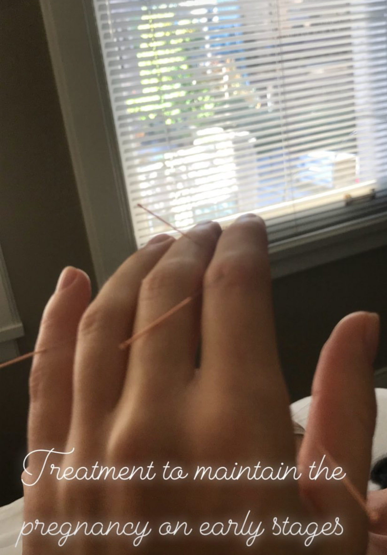  SuJok acupuncture treatments based in Vancouver used for fertility and reproductive health. Patient is treated to maintain pregnancy in first stages.  
