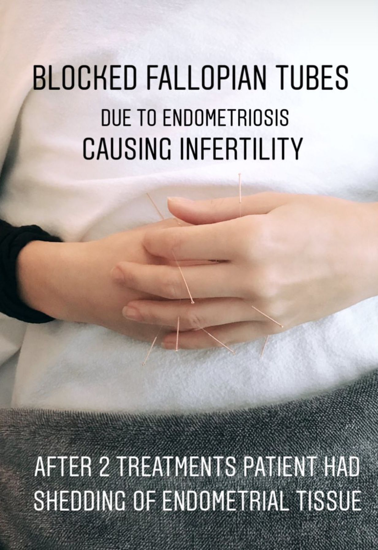  SuJok acupuncture in Vancouver used as treatment for fertility and reproductive health. Patient was treated for blocked Fallopian Tubes causing infertility. Treatment resulted in the successful clearing of tubes and shedding of the endometrium  