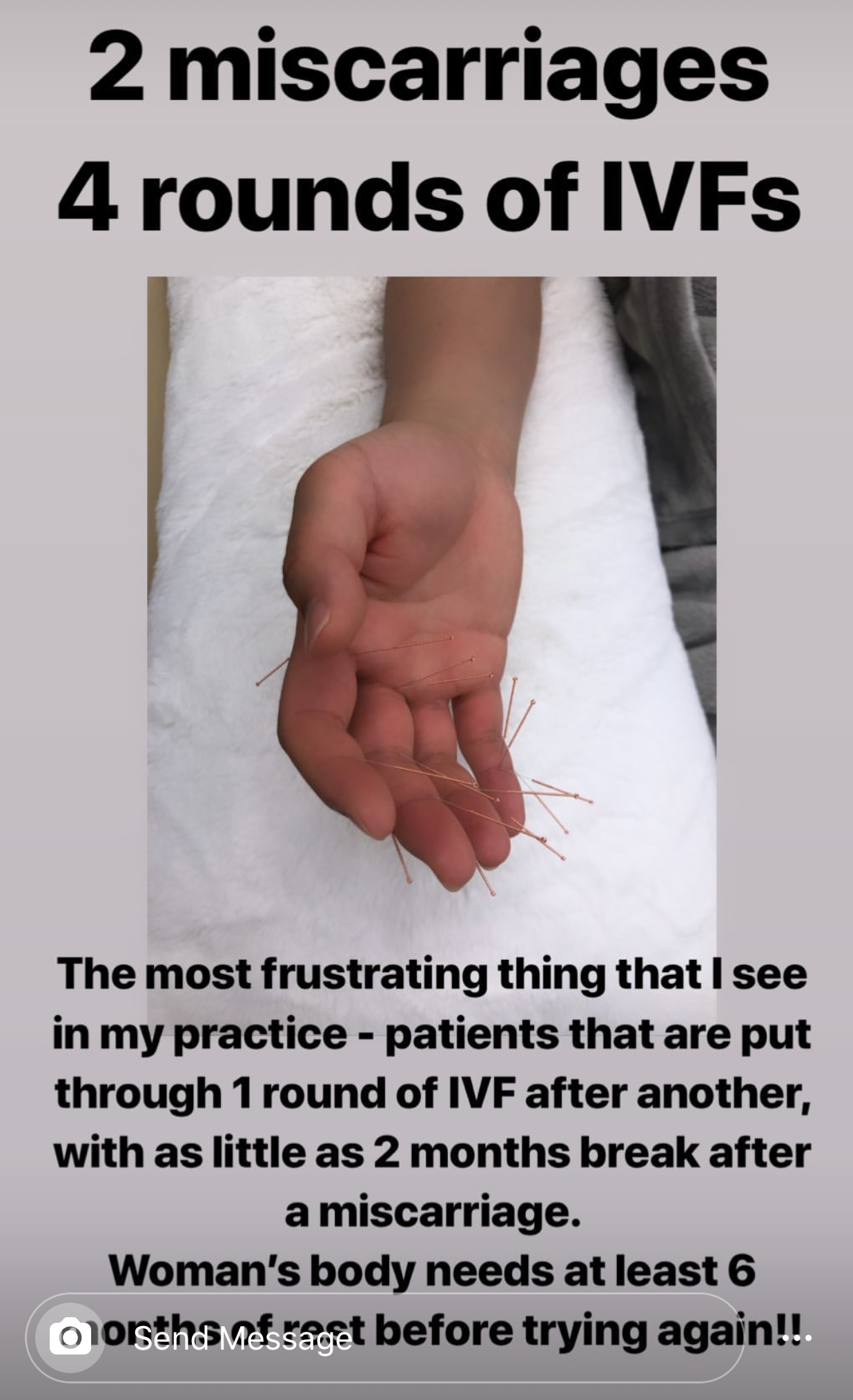  SuJok acupuncture treatments based in Vancouver used for fertility and reproductive health. Patient is treated for suffering from two miscarriages and undergoing four In Vitro Fertilization IVFs.  