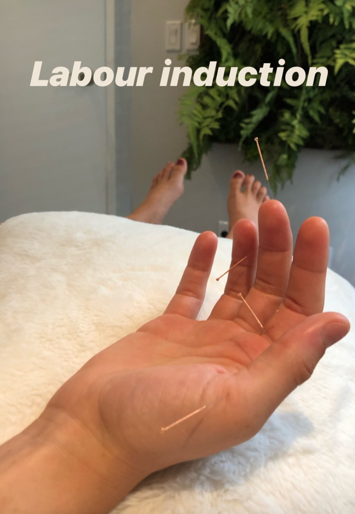  SuJok acupuncture in Vancouver used to treat fertility and reproductive health. Patient receives treatment for labor induction  
