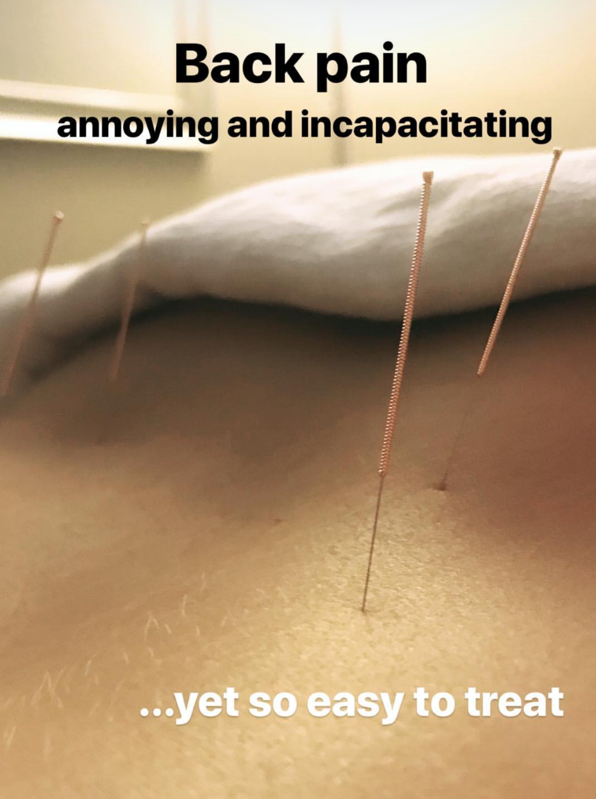  Acupuncture treatment based in Vancouver used for pain syndrome on patient with incapacitating back pain 
