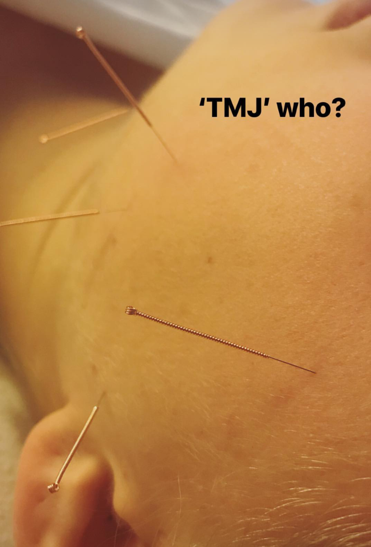  Acupuncture treatments based in Vancouver used to treat Temporomandibular Joint pain  