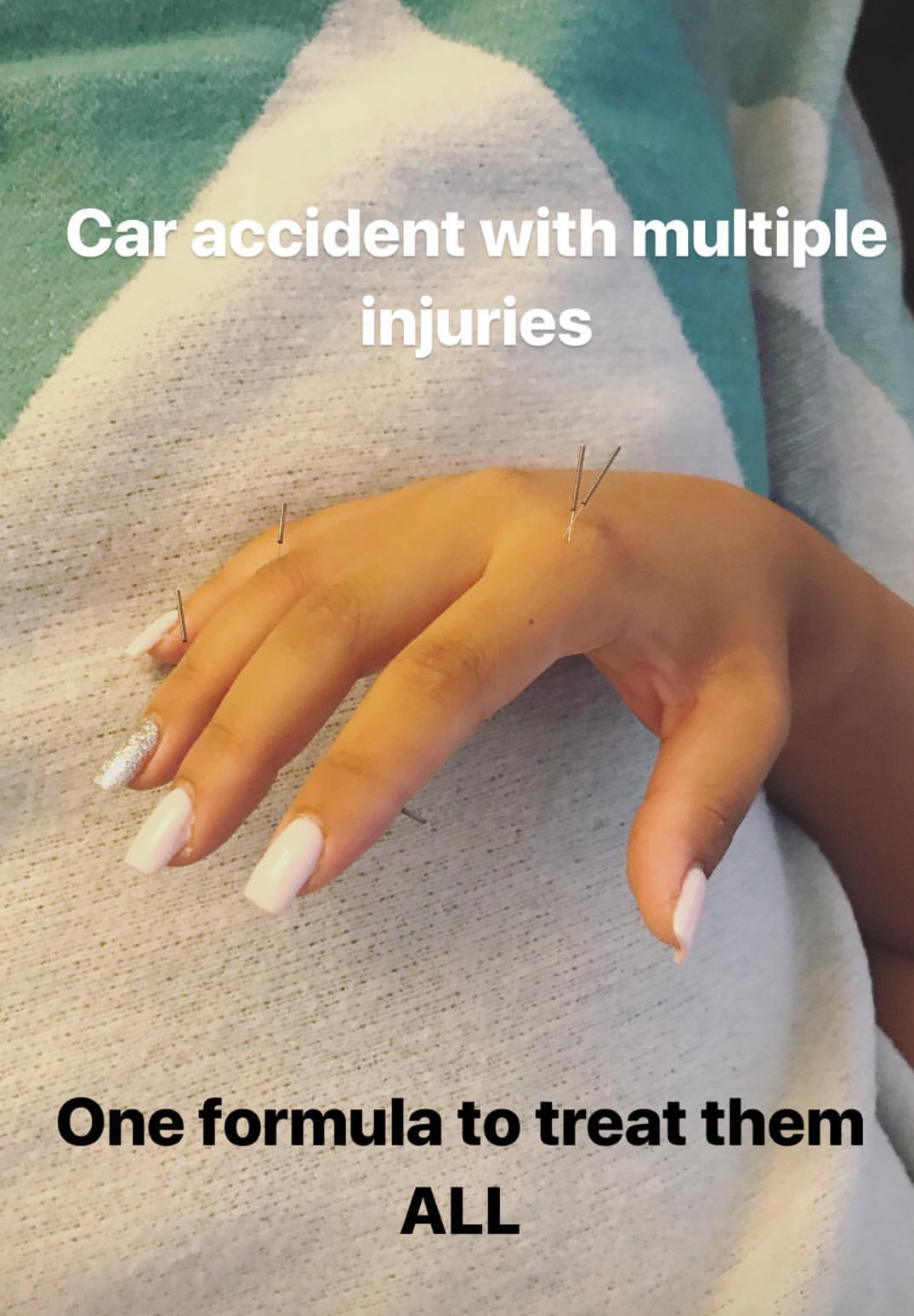  SuJok acupuncture in Vancouver used to treat patients with pain syndrome, in this case as a result of a car accident. Treatment focused on using a single formula to treat multiple issues.  