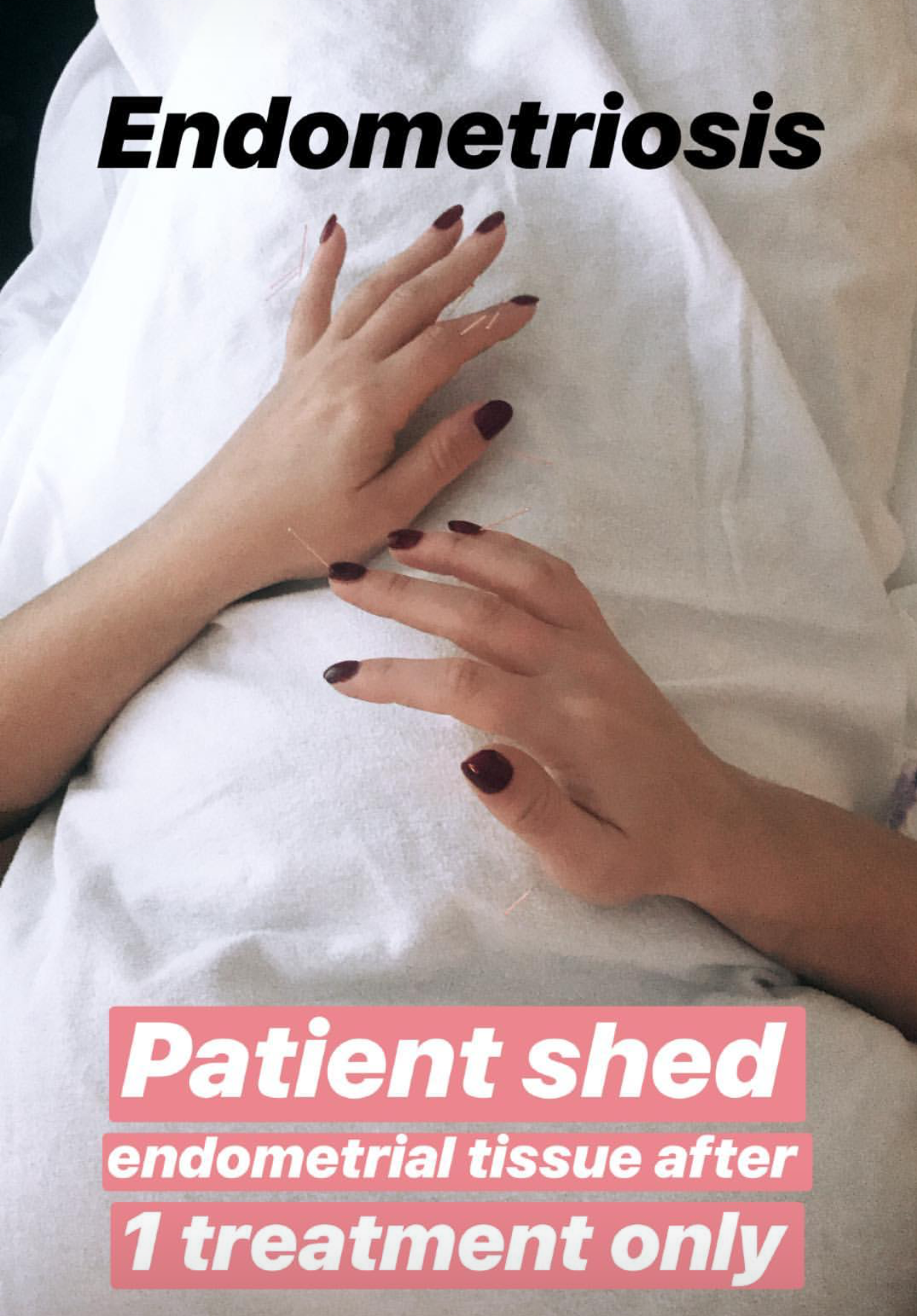  SuJok acupuncture in Vancouver used for treating reproductive system conditions. Patient receives treatment for endometriosis. Treatment resulted in the successful shedding on the endometrium after one treatment.  