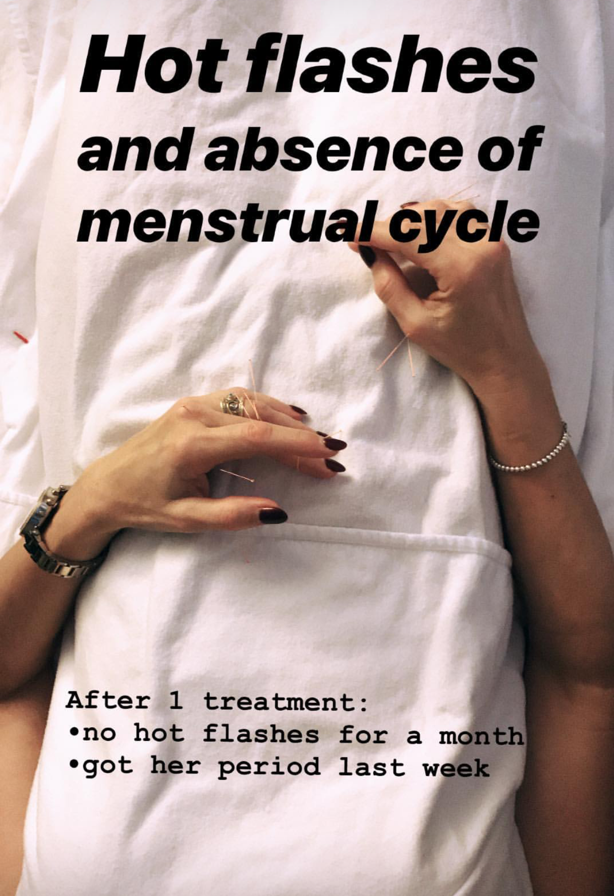  SuJok acupuncture in Vancouver used for treating reproductive system conditions. Patient receives treatment for having a imbalanced menstrual cycle. Treatment results in elimination of hot flashes and inducing a regular period cycle.  