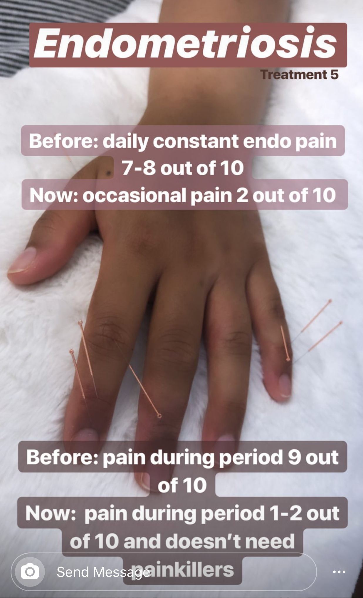  SuJok acupuncture in Vancouver used for treating reproductive system conditions. Patient receives treatment for pain caused by endometriosis. Treatment results in the successful elimination of pain 