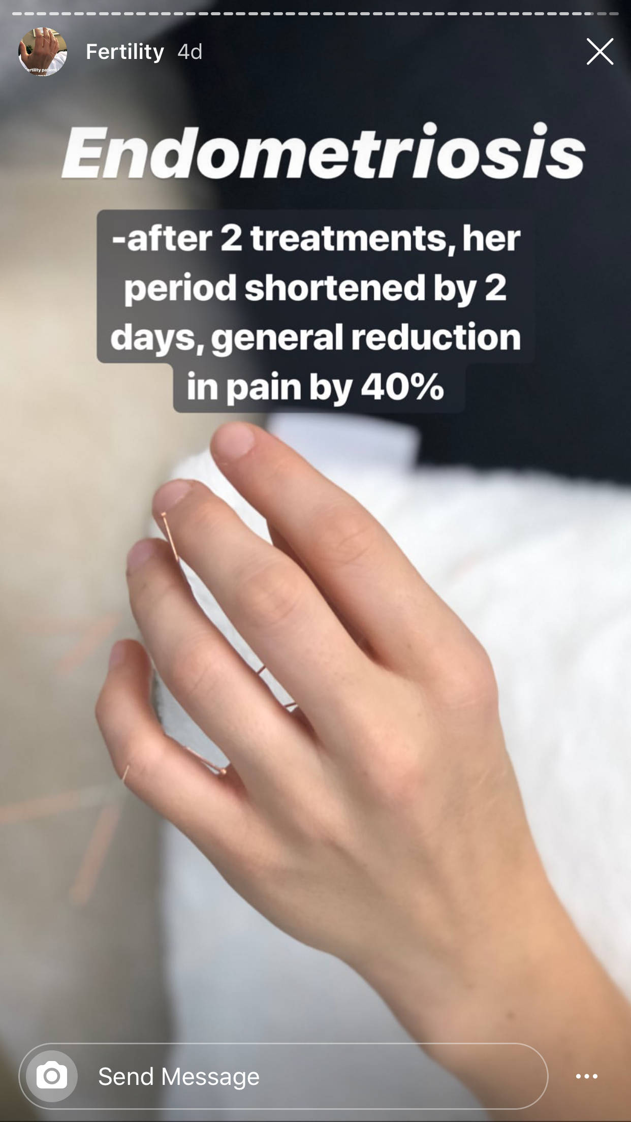  SuJok acupuncture in Vancouver used for treating reproductive system conditions. Patient receives treatment for endometriosis. treatments result in reduction of pain by 40% and a shorter period.  