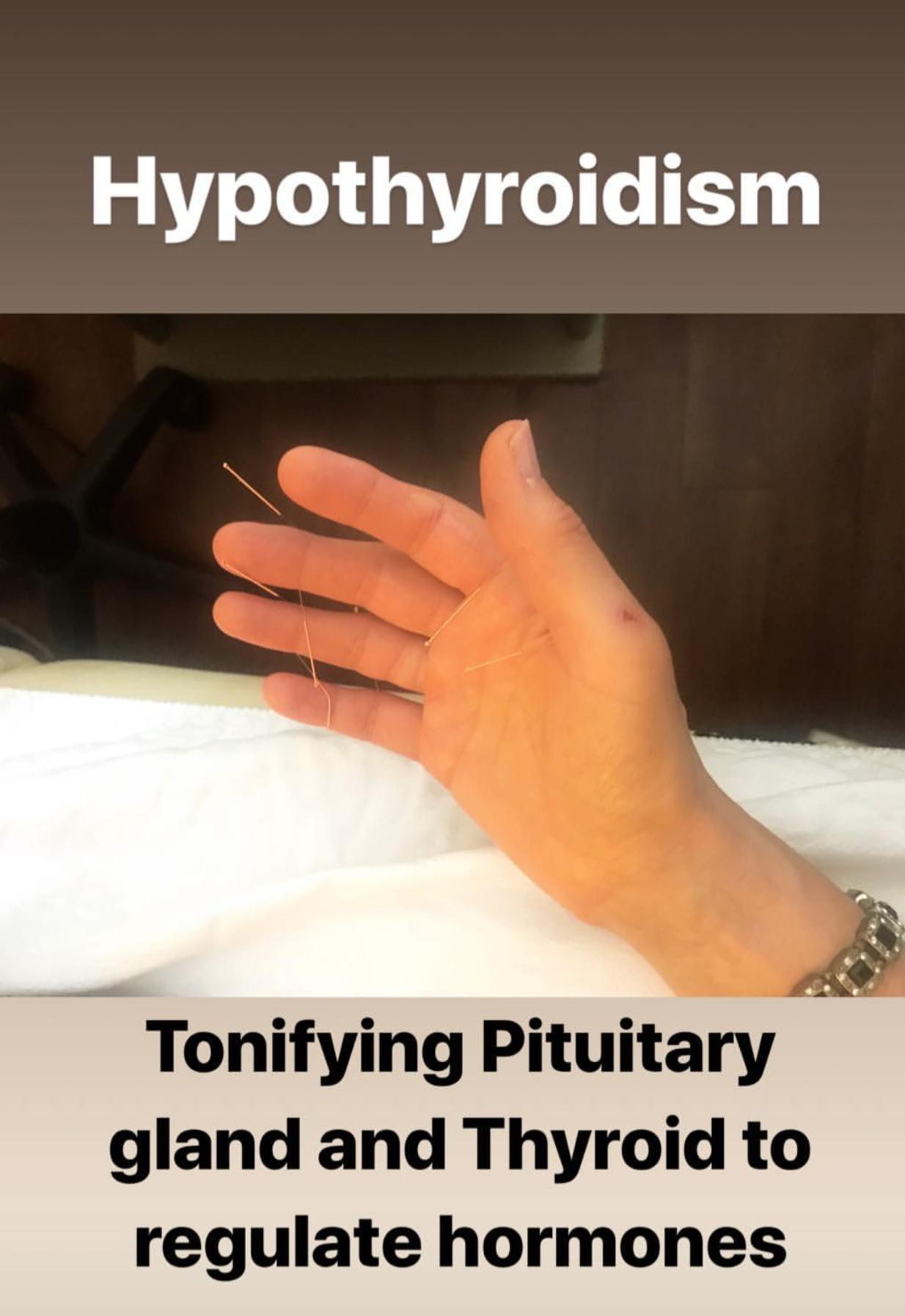  SuJok acupuncture in Vancouver used to treat hormonal issues and conditions. Patient receives treatment for hypothyroidism and focuses on toning the pituitary gland and thyroid to regulate and balance hormones.  