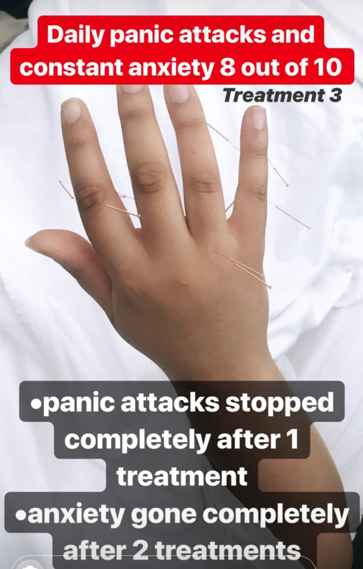  SuJok acupuncture in Vancouver used for treating mental health issues. Patient received treatment for daily panic attacks and constant anxiety. Treatment resulted in the successful elimination of panic attacks and anxiety after second treatment. 