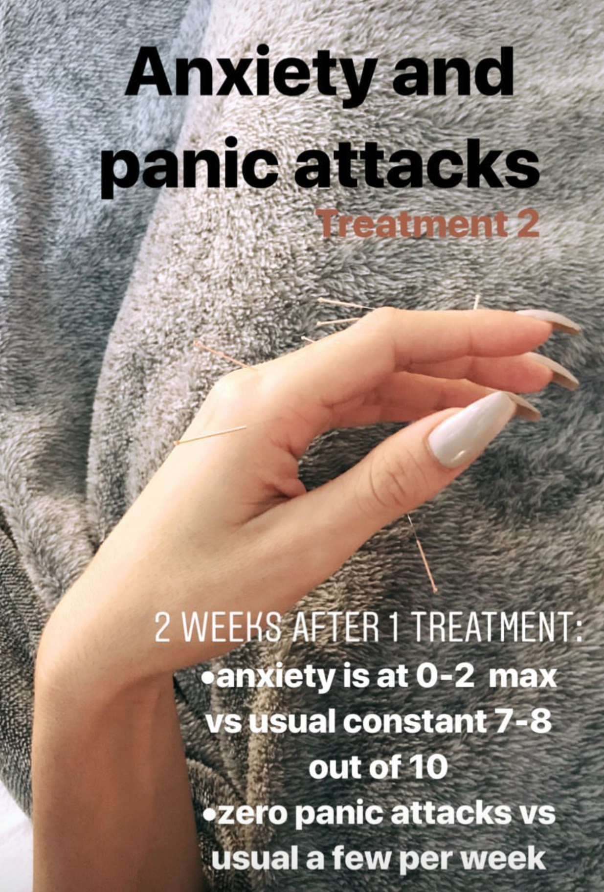  SuJok acupuncture in Vancouver used for treating mental health issues. Patient received treatment for anxiety and panic attacks. Treatment results in the successful reduction of panic and anxiety attacks  