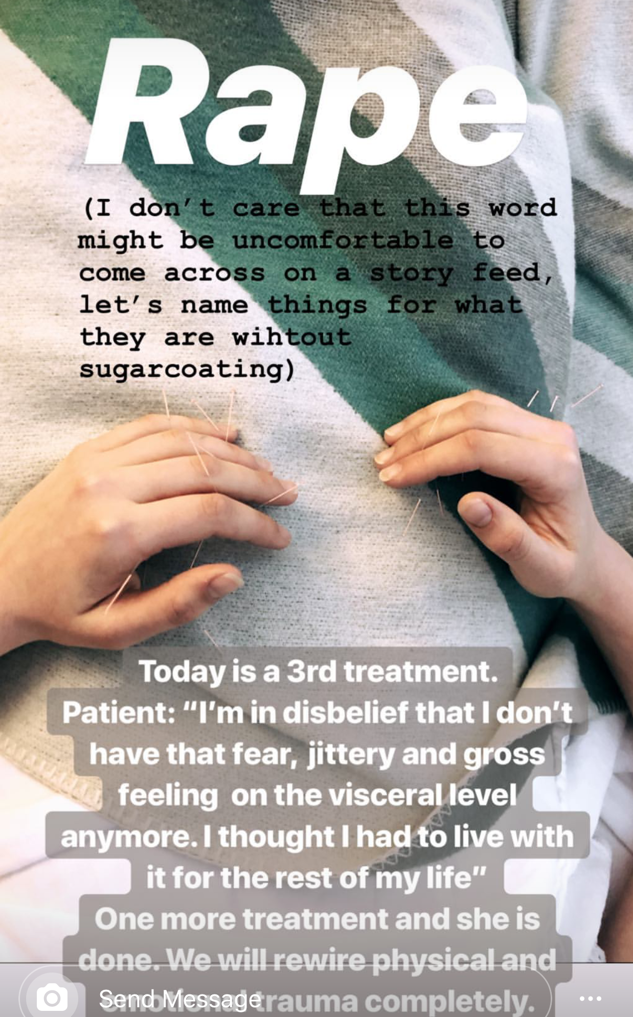  SuJok acupuncture in Vancouver used for treating mental health issues. Patient received treatment for emotional effects of being raped. After third treatment, patient is no longer feeling negatively towards herself and her sexuality  