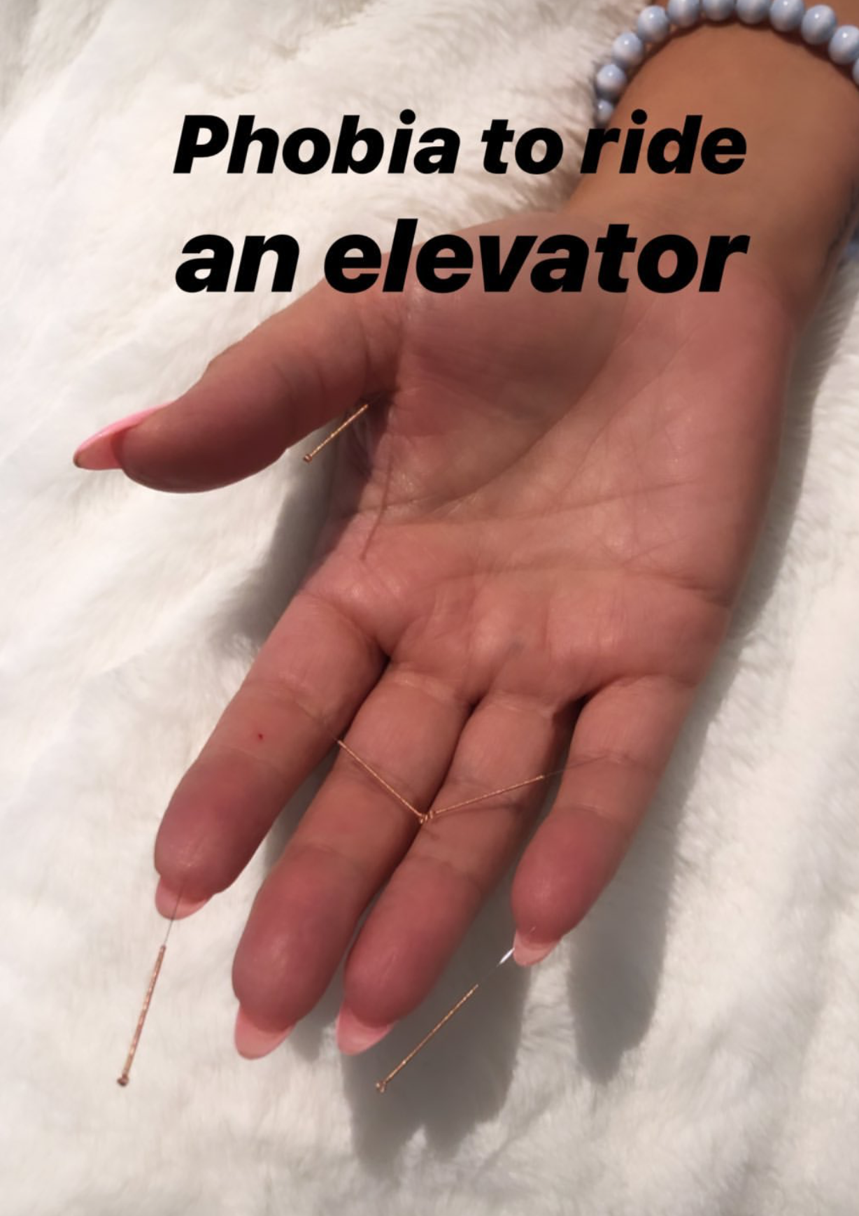  SuJok acupuncture in Vancouver used for treating mental health. Patient received treatment for phobia of riding elevators.  