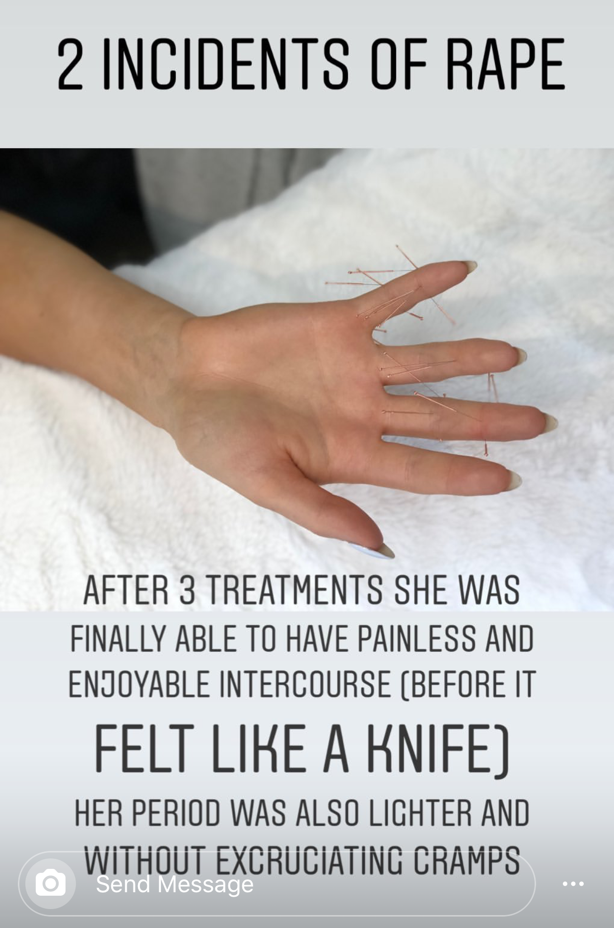  SuJok acupuncture in Vancouver used for treating mental health. Patient received treatment for having two incidents of rape. Treatments focused on removing emotional trauma and enabling her to have painless intercourse, as well as reducing menstrual