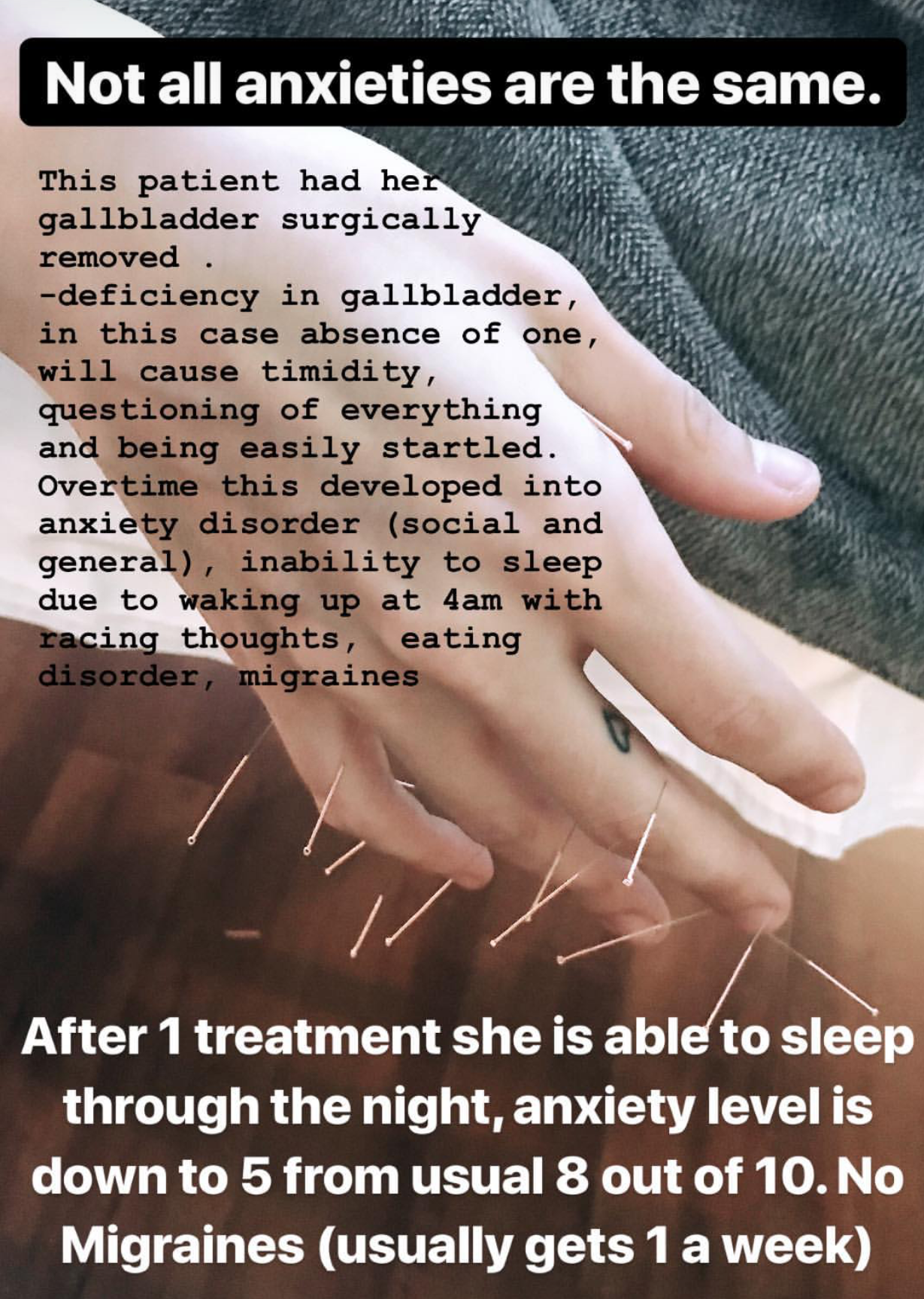  SuJok acupuncture in Vancouver used for treating mental health. Patient received treatment after having her gallbladder removed and experiencing anxiety due to it. Treatment resulted in improvement of sleeping schedules and reducing anxiety.  