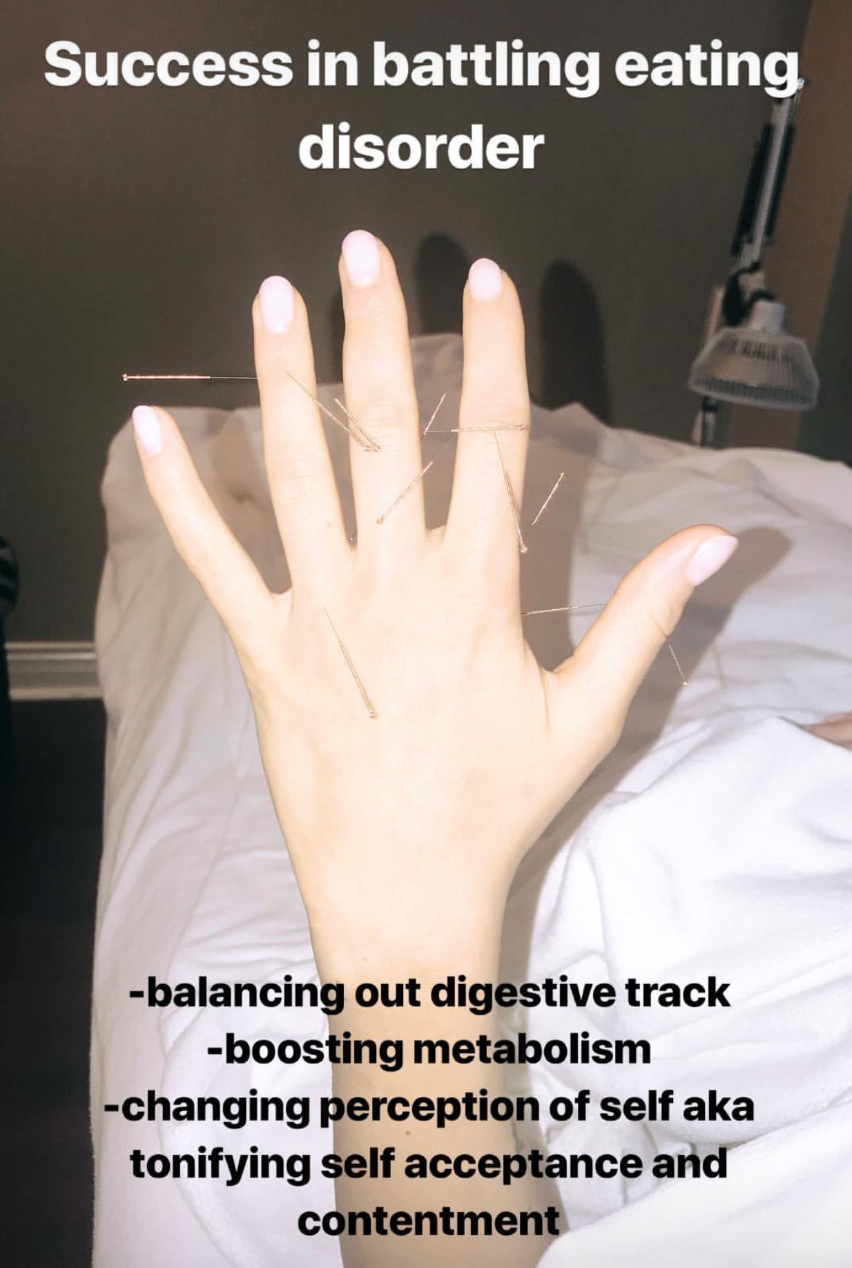  SuJok acupuncture in Vancouver used for treating mental health. Patient received treatment for bulimia. Treatment resulted in successfully in balancing out digestive tract, boosting metabolism and working on self-esteem.  