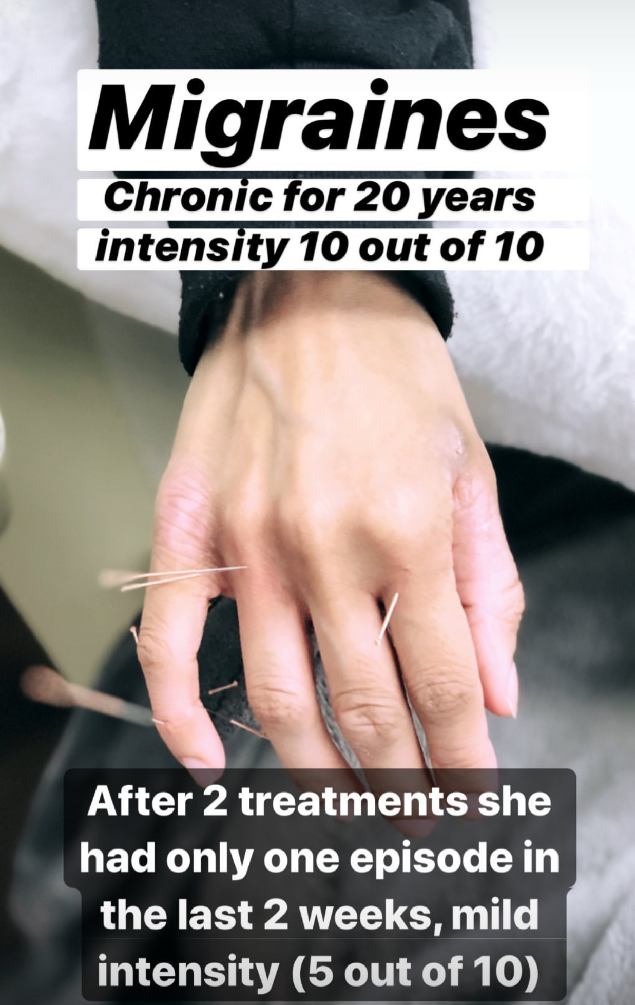  SuJok acupuncture in Vancouver used as treatment for Migraines. Patient received treatment for chronic migraines for 10 years. After 2 treatments, she had reduced pain intensity and reduced episodes.  