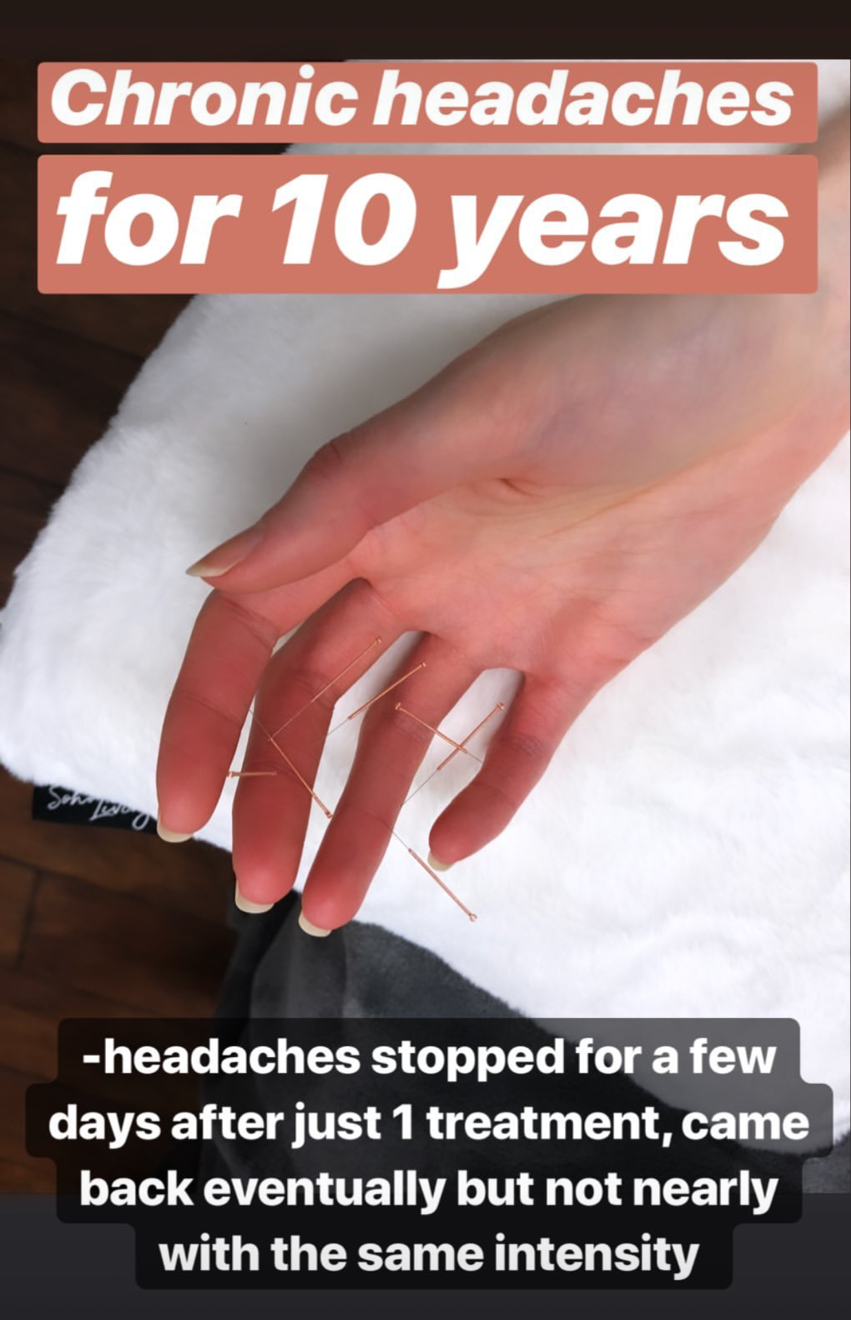  SuJok acupuncture in Vancouver used to treat pain syndrome. Patient received treatment for chronic headaches. Treatment resulted in the successful reduction of intensity. 