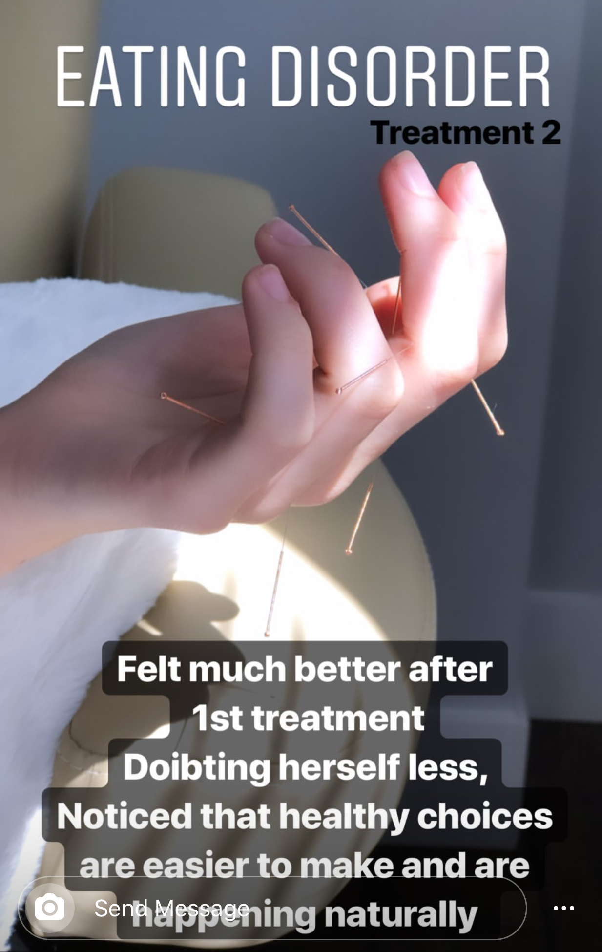  SuJok acupuncture in Vancouver used to treat eating disorders. Patient received treatment for an eating disorder. First treatment resulted in the successful improvement in self-esteem and easy healthy lifestyle choices being made.  