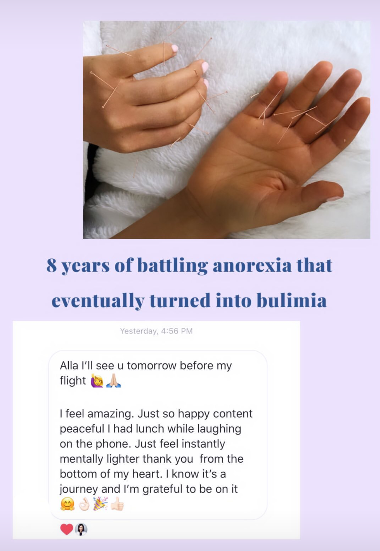  SuJok acupuncture in Vancouver used to treat eating disorders. Patient received treatment for anorexia that evolved into bulimia. Treatment resulted in the successful elimination of bulimia and improvement in self-esteem and energy.  