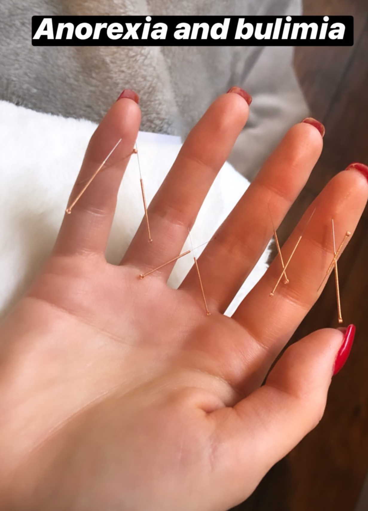  SuJok acupuncture in Vancouver used to treat eating disorders. Patient received treatment for anorexia and bulimia 