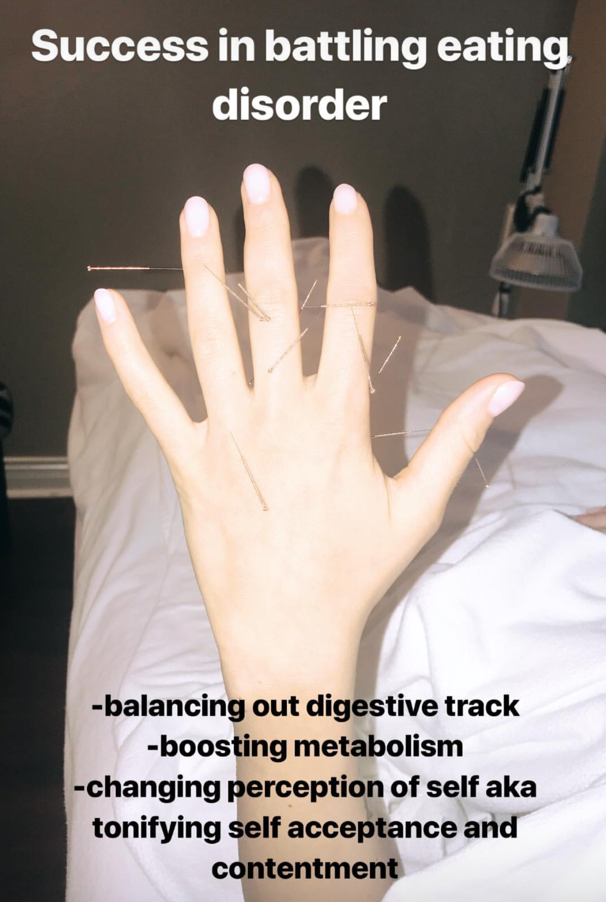  SuJok acupuncture in Vancouver used to treat eating disorders. Patient received treatment for eating disorder and was able to improve metabolism and digestive tract health, as well as self-esteem 