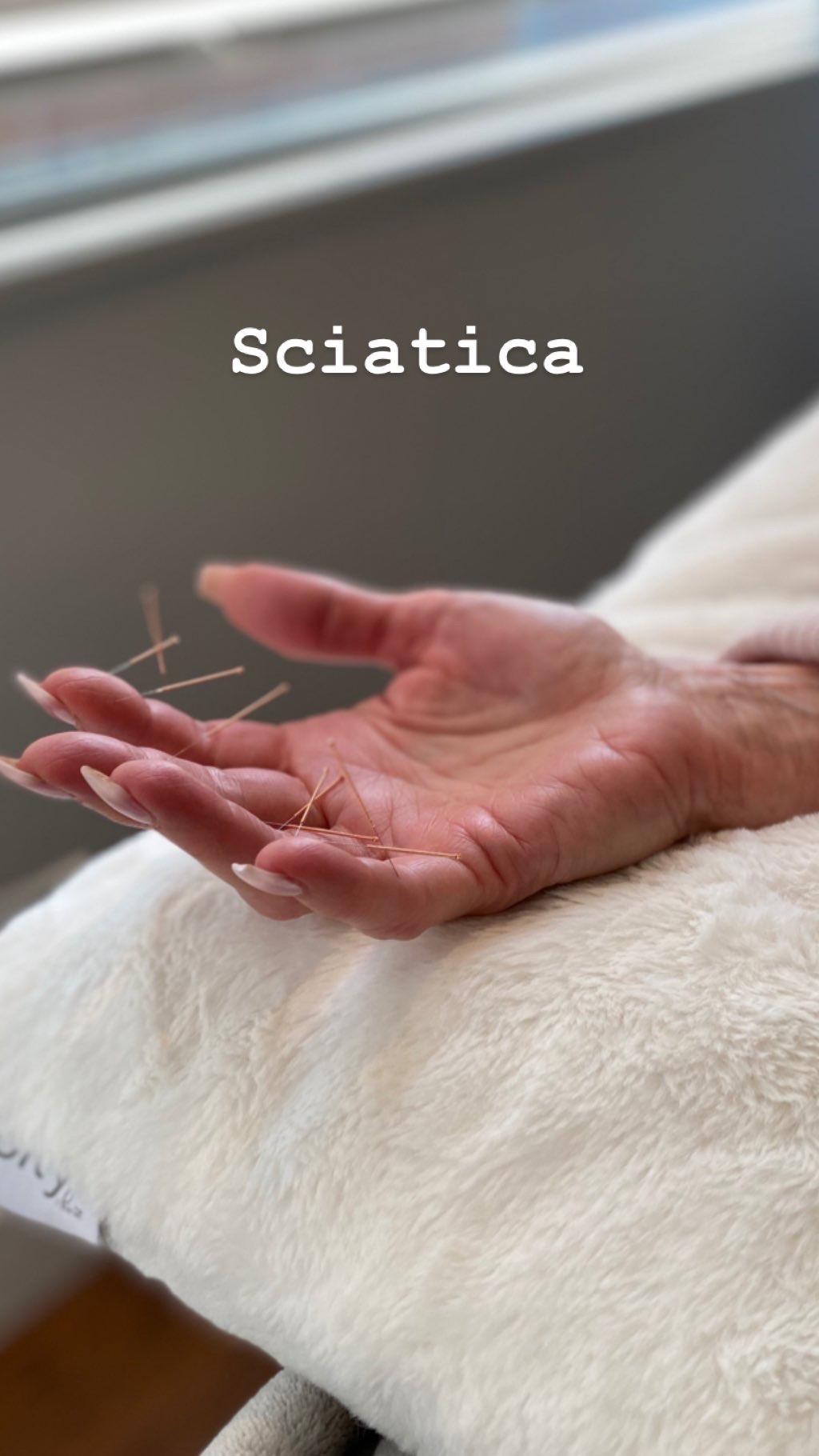  SuJok acupuncture in Vancouver used to treat pain syndrome. Patient received treatment for sciatica nerve-related pain.  