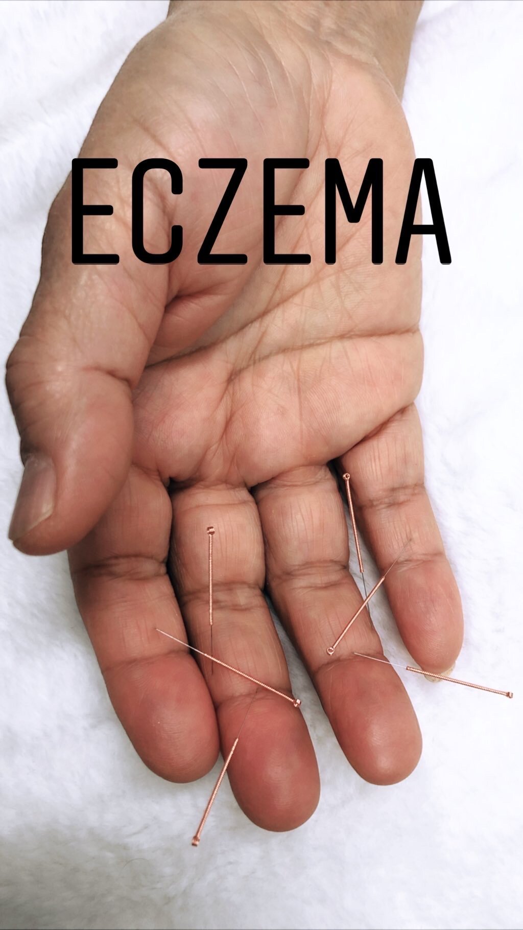  SuJok acupuncture in Vancouver used to treat skin diseases and conditions. Patient received treatment for eczema 