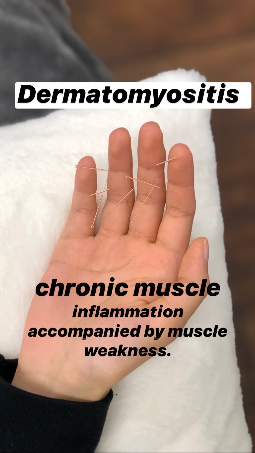  SuJok acupuncture in Vancouver used to treat skin diseases and conditions. Patient received treatment for dermatomyositis causing chronic muscle inflammation and weakness.  