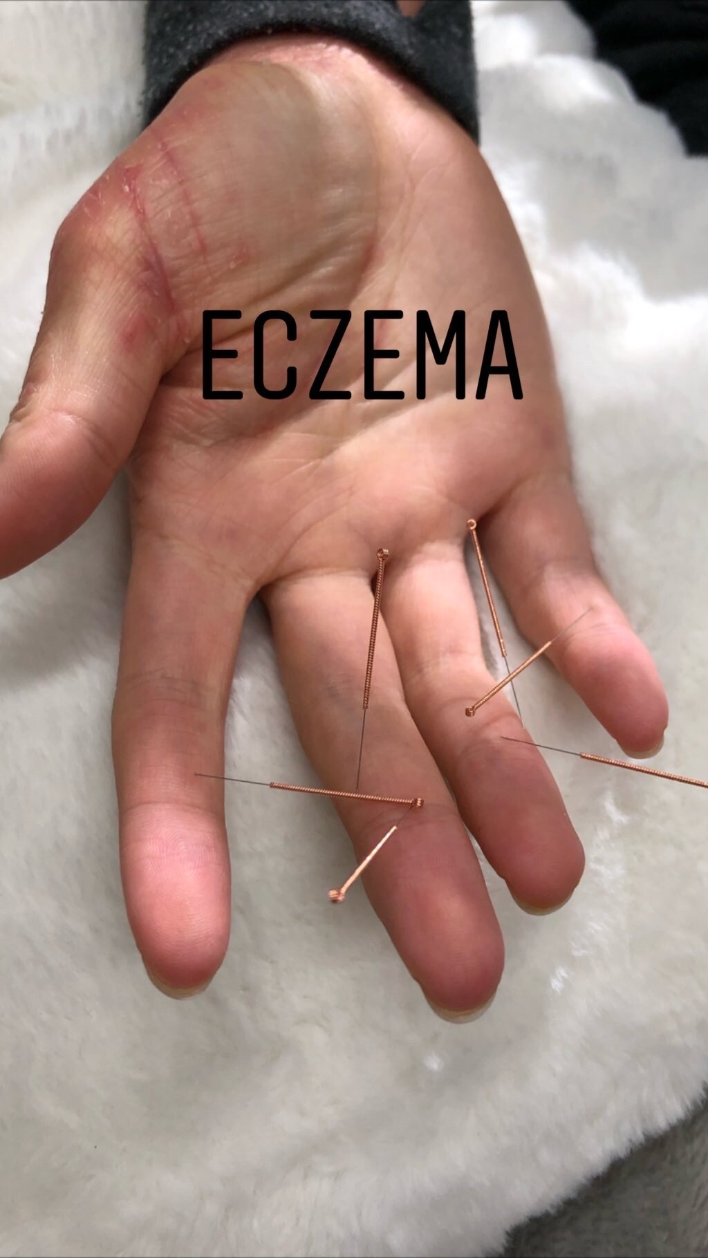  SuJok acupuncture in Vancouver used to treat skin diseases and conditions. Patient received treatment for eczema 