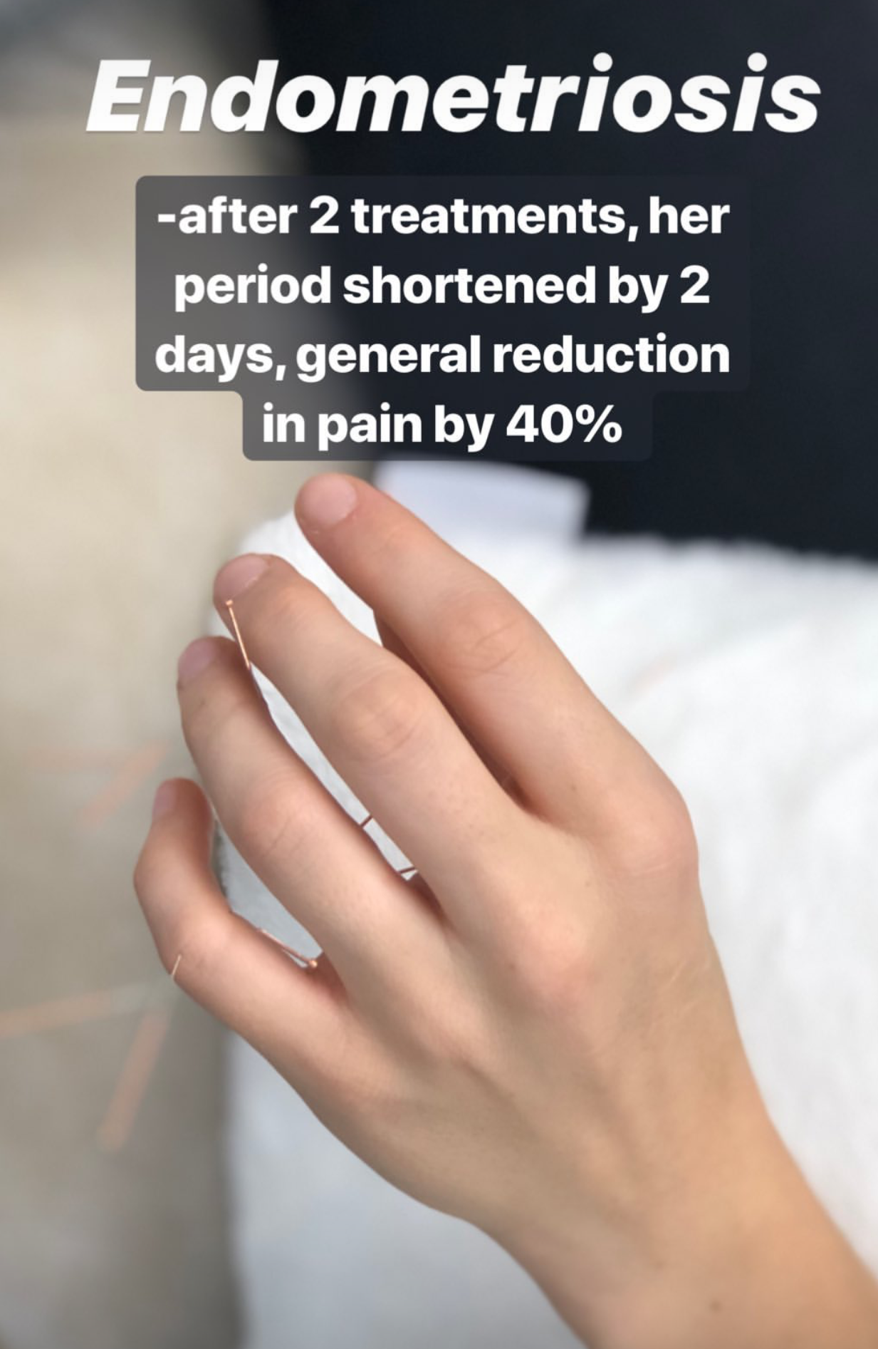  SuJok acupuncture in Vancouver used to treat fertility and reproductive health. Patient received treatment for endometriosis, which resulted in the 40% reduction of pain and shorter period cycle.  