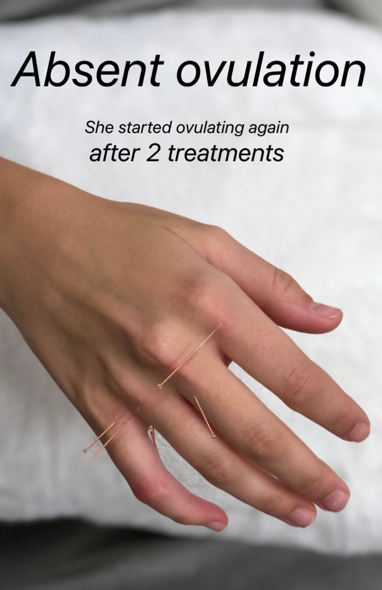  SuJok acupuncture in Vancouver used to treat fertility and reproductive health. Patient received treatment for absent ovulation, which resulted in her ovulation cycles to resume 