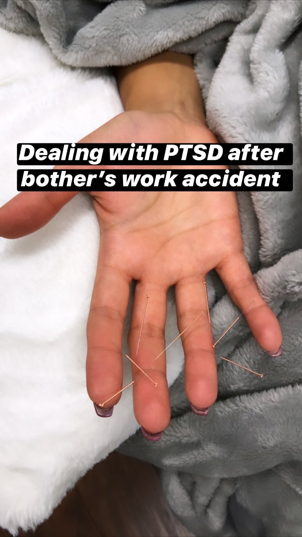  SuJok acupuncture in Vancouver used to treat mental health. Patient received treatment for Post Traumatic Stress Disorder PTSD after brother’s work accident 
