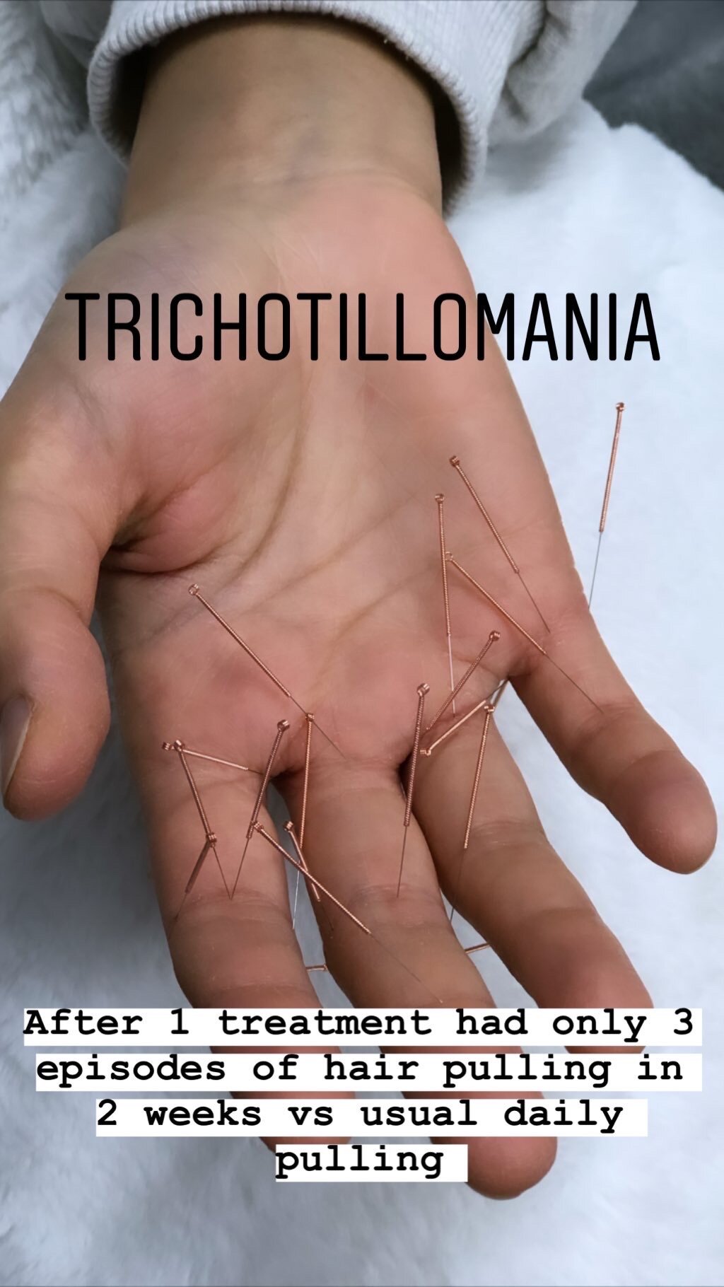  SuJok acupuncture in Vancouver used to treat mental health. Patient received treatment for trichotillomania, which resulted in the successful decrease in hair pulling incidents.  