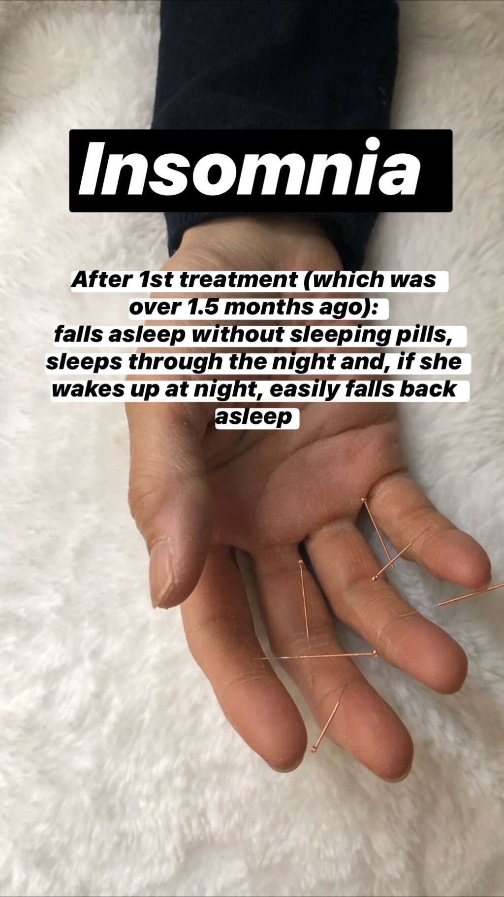  SuJok Acupuncture in Vancouver used as alternative treatment for insomnia. Patient was able to sleep normally after first treatment.  