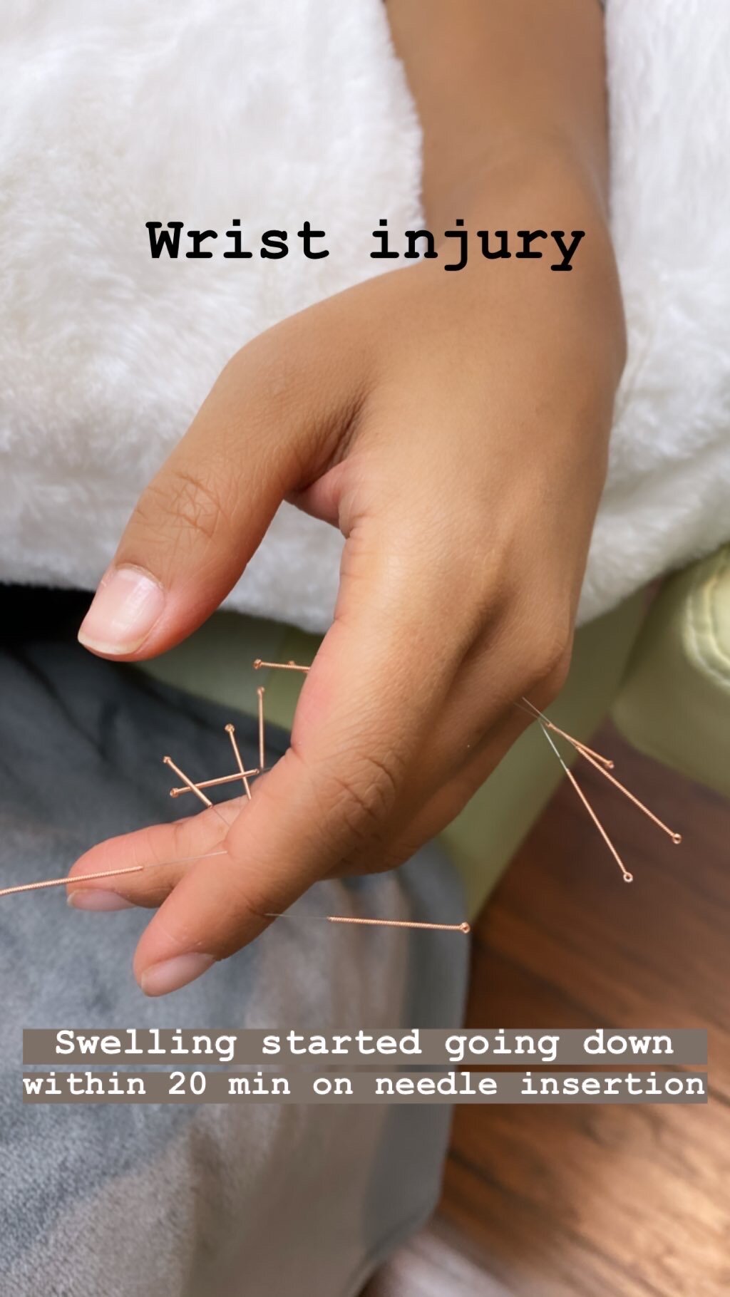  SuJok acupuncture in Vancouver used for treating pain syndrome. Patient received treatment for wrist injury, which resulted in the immediate pain relief and swelling reduction after needle insertion.  