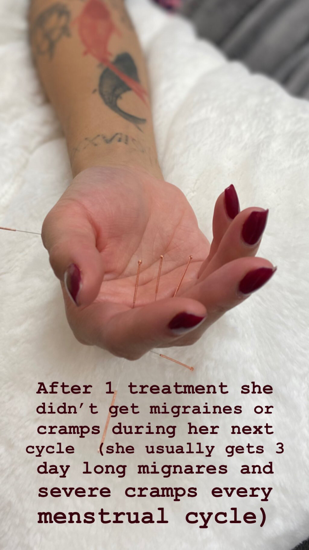  SuJok acupuncture in Vancouver used to treat reproductive system conditions and issues. Patient received treatment for severe menstrual side effects such as chronic migraines.  