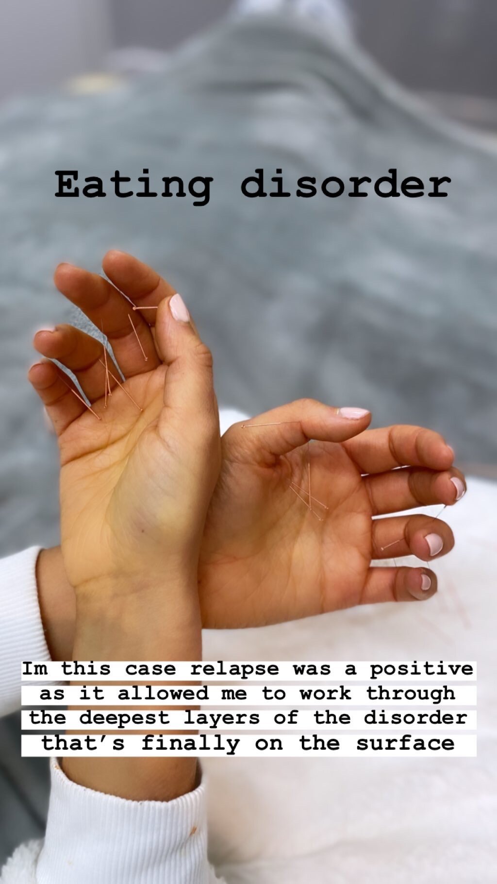  SuJok acupuncture in Vancouver used to treat eating disorders. Patient received treatment for relapsed eating disorder.  