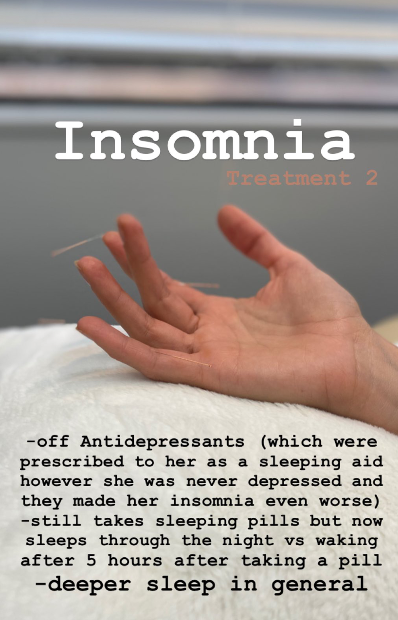  SuJok acupuncture in Vancouver used for treating Insomnia. Patient received treatment for being wrongfully prescribed antidepressants that unbalanced her sleeping habits. Acupuncture resulted in the improvement of sleeping schedules and change in pr