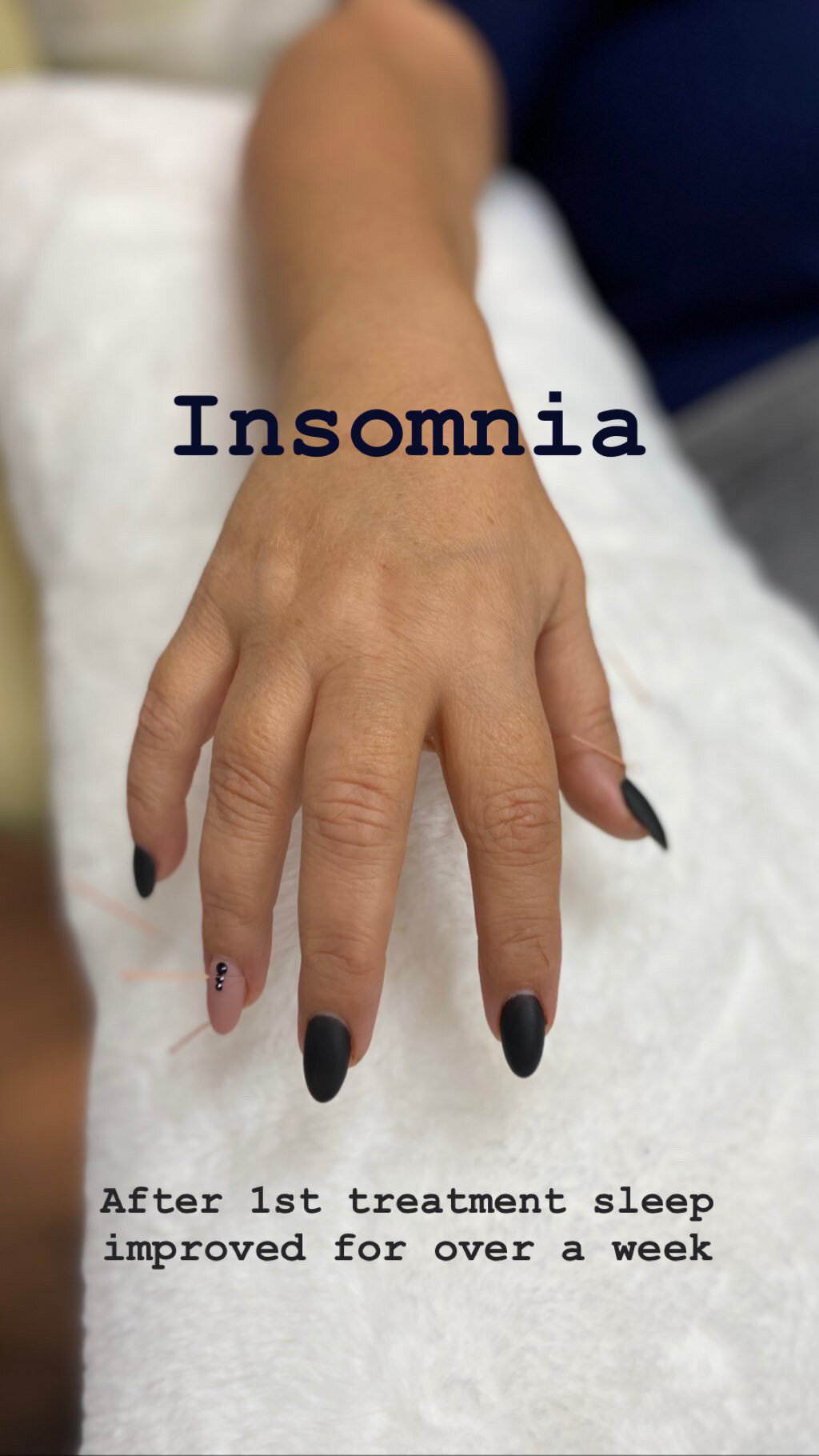  SuJok acupuncture in Vancouver used for treating Insomnia. Patient’s treatment resulted in the ability to sleep after one treatment.  