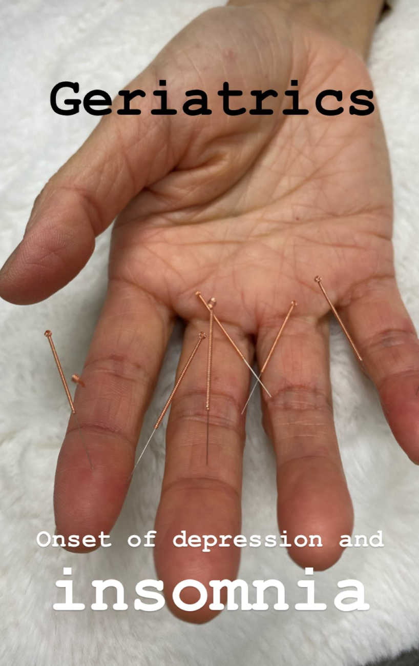  SuJok acupuncture in Vancouver used for treating Insomnia. Patient received treatment for onset of depression and insomnia 
