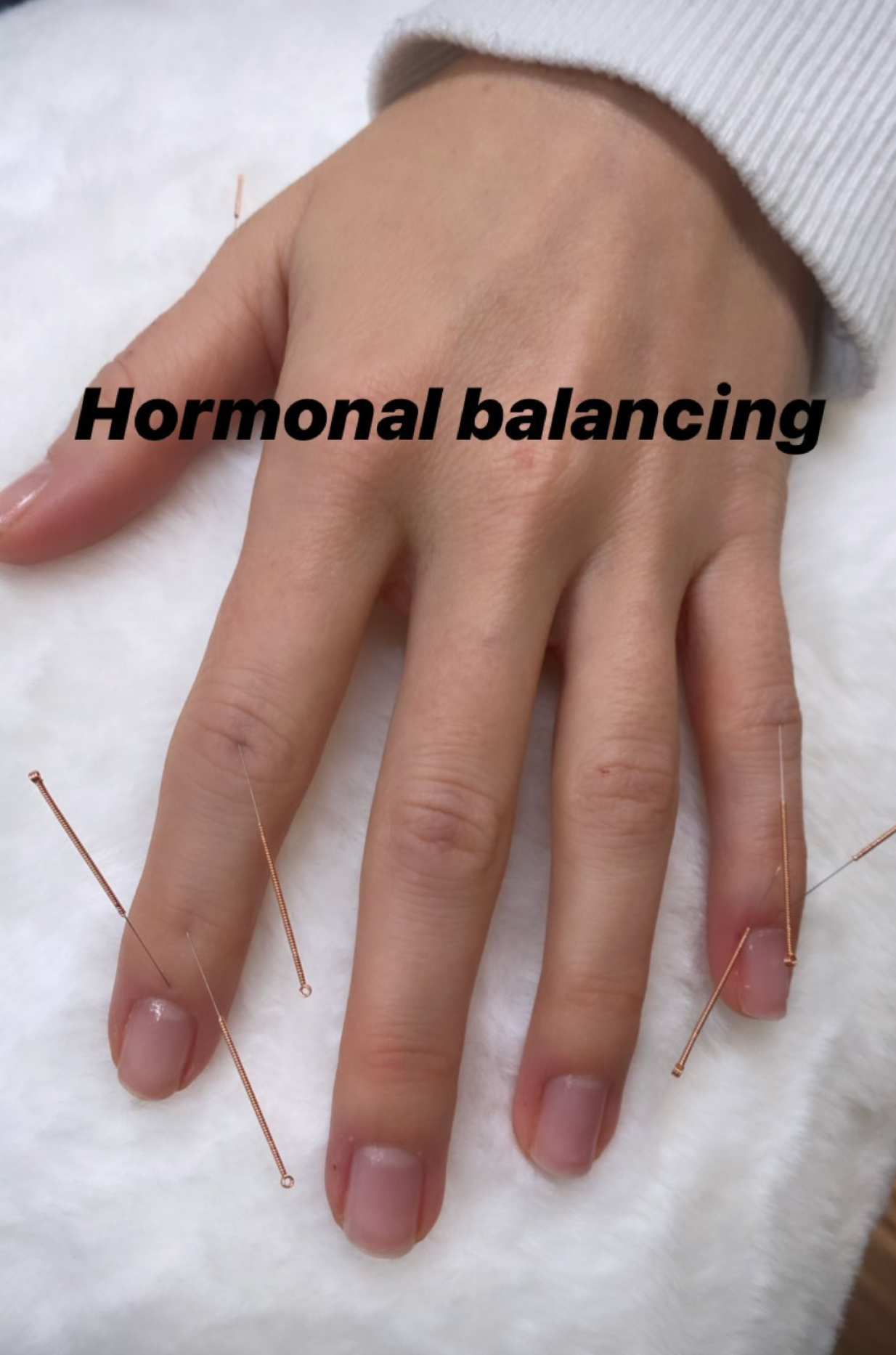  SuJok Acupuncture in Vancouver used to treat patients for Hormonal Balancing. Patient was treated for hormonal balancing 