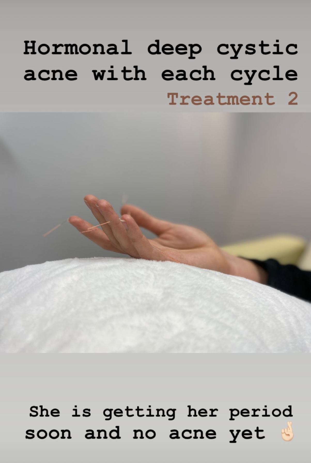  SuJok Acupuncture in Vancouver used to treat patients for Hormonal Balancing. Patient was treated for cystic acne appearing on each menstrual cycle. Treatments have resulted in elimination of acne outbreak. 