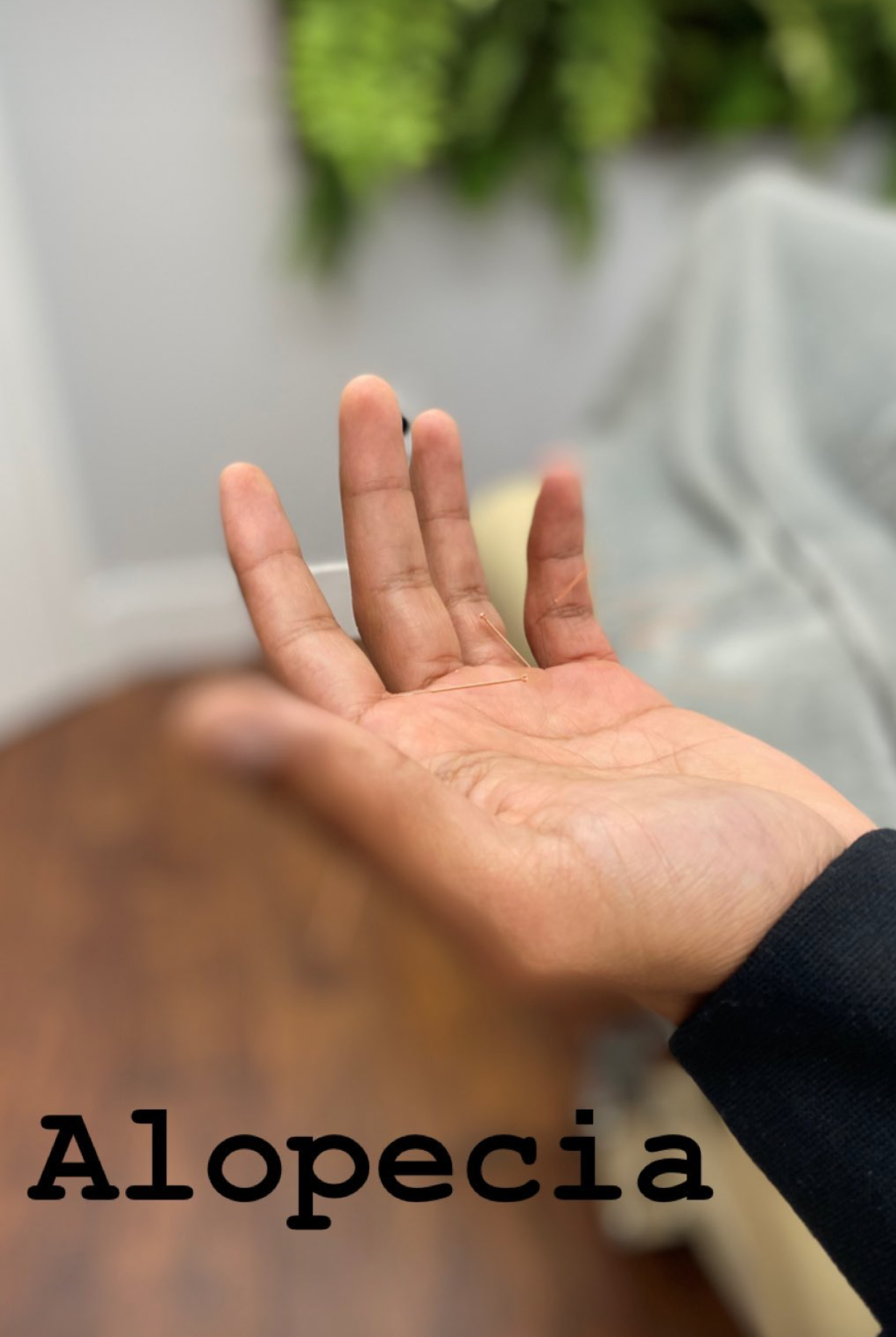  SuJok acupuncture in Vancouver used for treating patients with Autoimmune disorders. Patient received treatment for Alopecia, causing hair loss.  