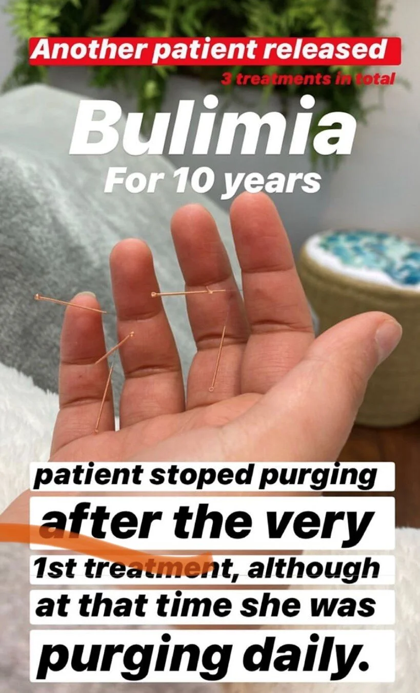  SuJok Acupuncture treatments based in Vancouver used for treating Eating disorders. Patient was released after suffering with Bulimia for 10 years. Treatments resulted in the elimination of purging. 