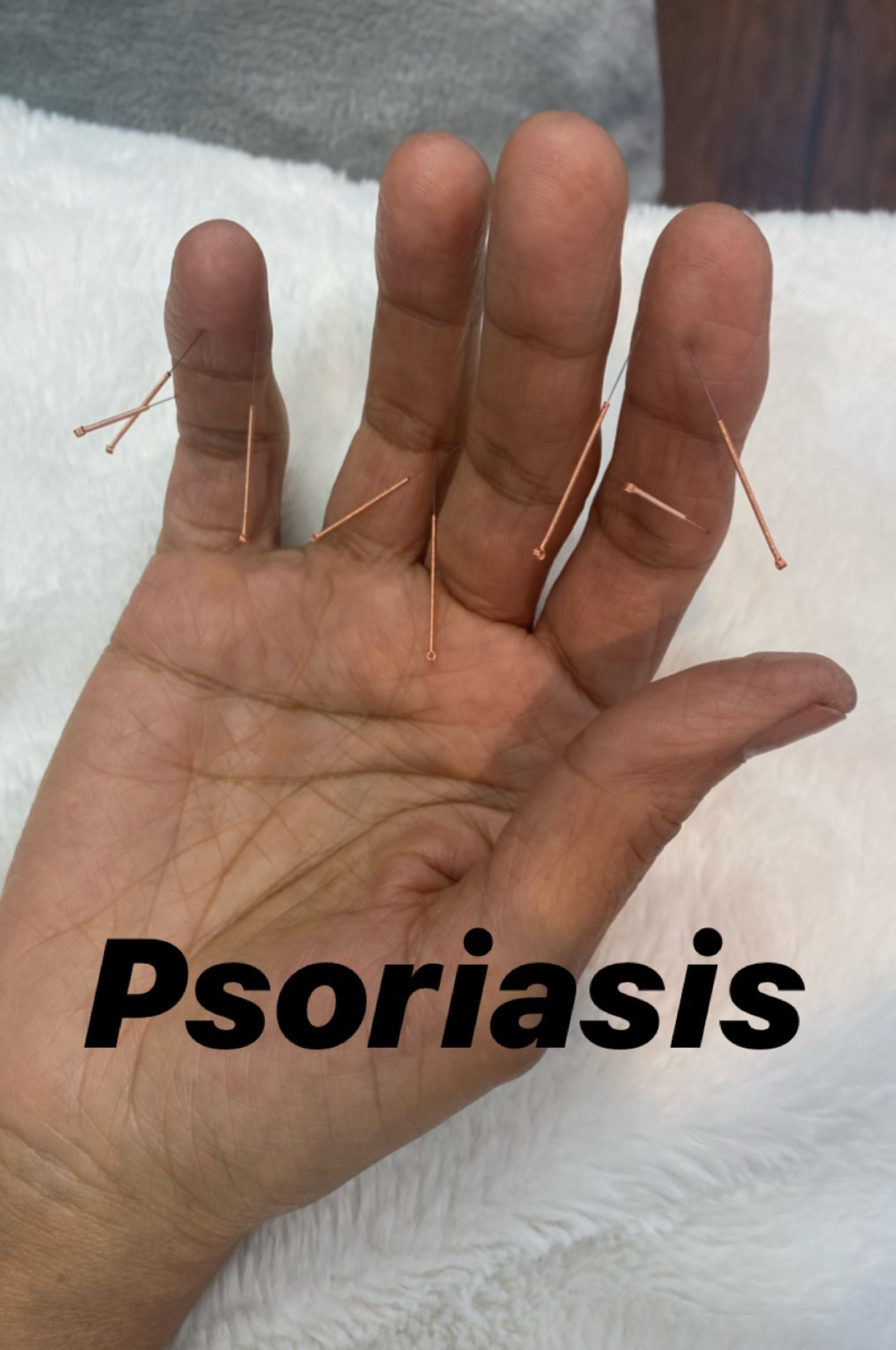  SuJok acupuncture treatments based in Vancouver used for skin issues and conditions. Patient in this case received treatment for psoriasis 