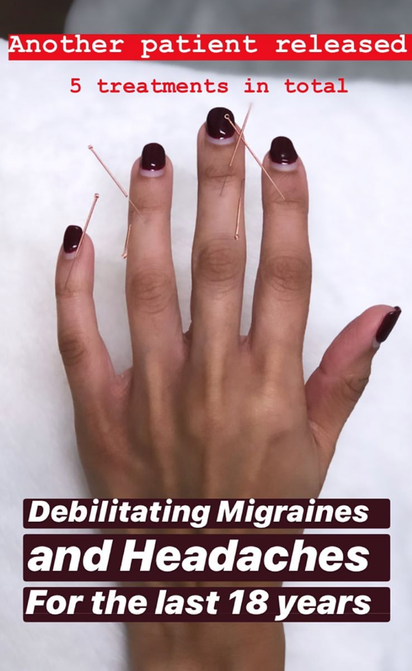  SuJok Acupuncture used to treat patients with Migraines. Patient was released after suffering from migraines for 18 years.  