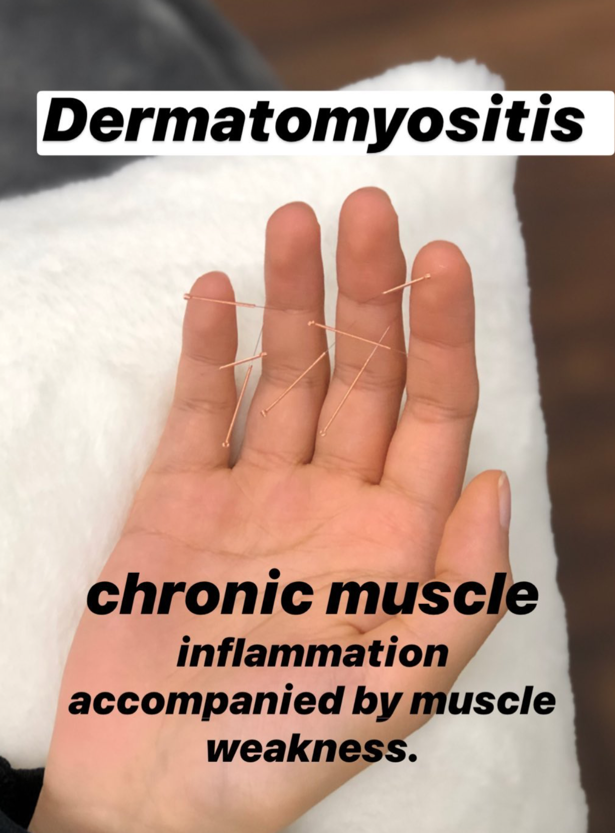  SuJok acupuncture based in vancouver at alla ozerova acuuncture clinic, used to treat autoimmune diseases like dermatomyositis. Patient was treated for chronic muscle pain accompanied by muscle weakness.  