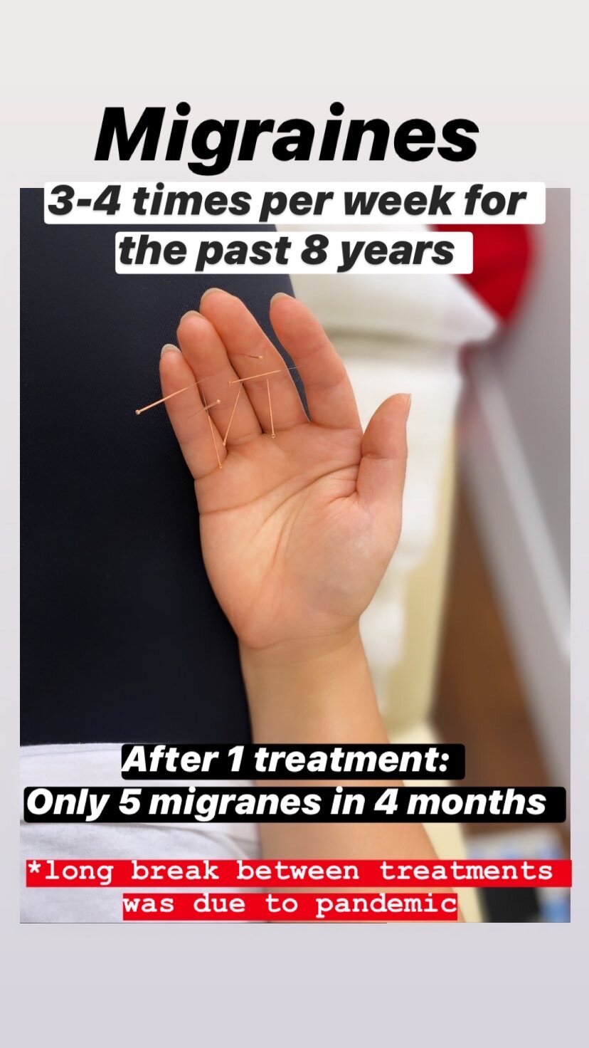  SuJok acupuncture based in vancouver at alla ozerova acupuncture clinic, used to treat migraines. Patient was experiencing pain 3-4 times per week for the past 8 years. After 1 treatment, migraines reduced to 5 migraines in 4 months.  