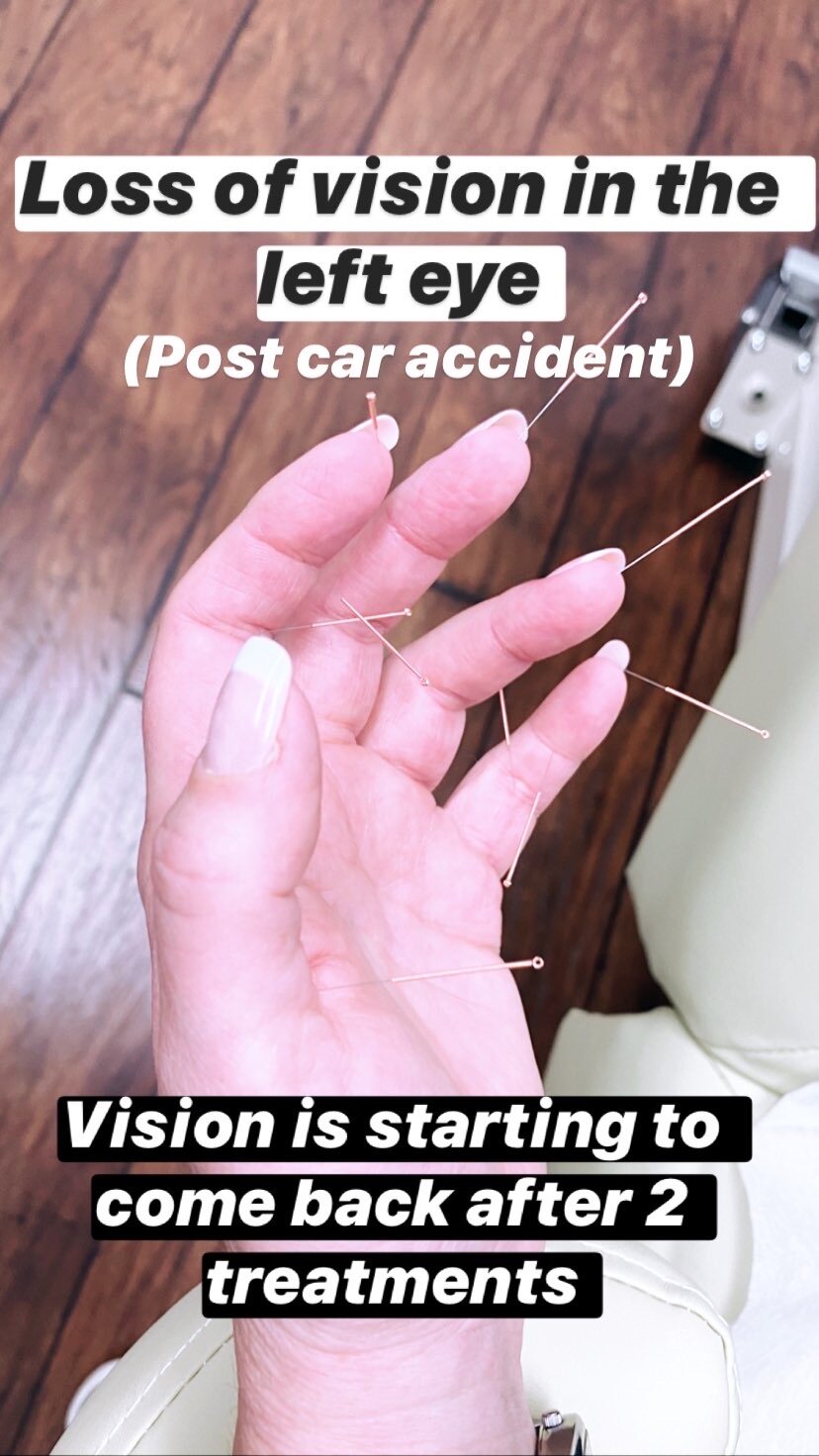  SuJok acupuncture based in vancouver at alla ozerova acupuncture clinic used as alternative to treating sensory issues and diseases. Patient was treated for loss of vision in the left eye after a car accident. Treatment resulted in vision coming bac