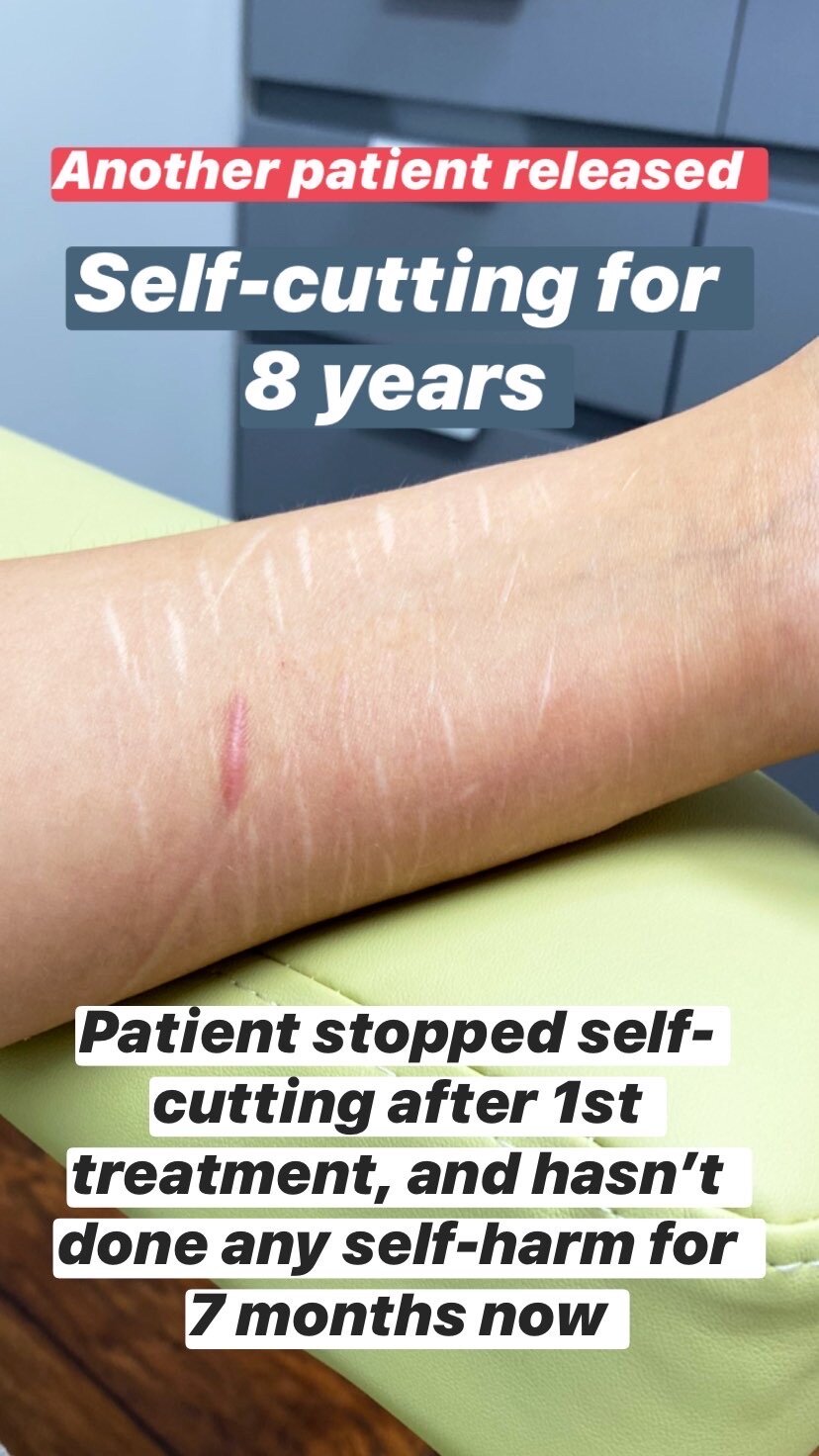  SuJok acupuncture based in vancouver at Alla Ozerova Acupuncture clinic used to treat mental health issues. Patient was treated for self harming. Patient stoped self-cutting since first treatment and has'n’t self harmed in 7 months 